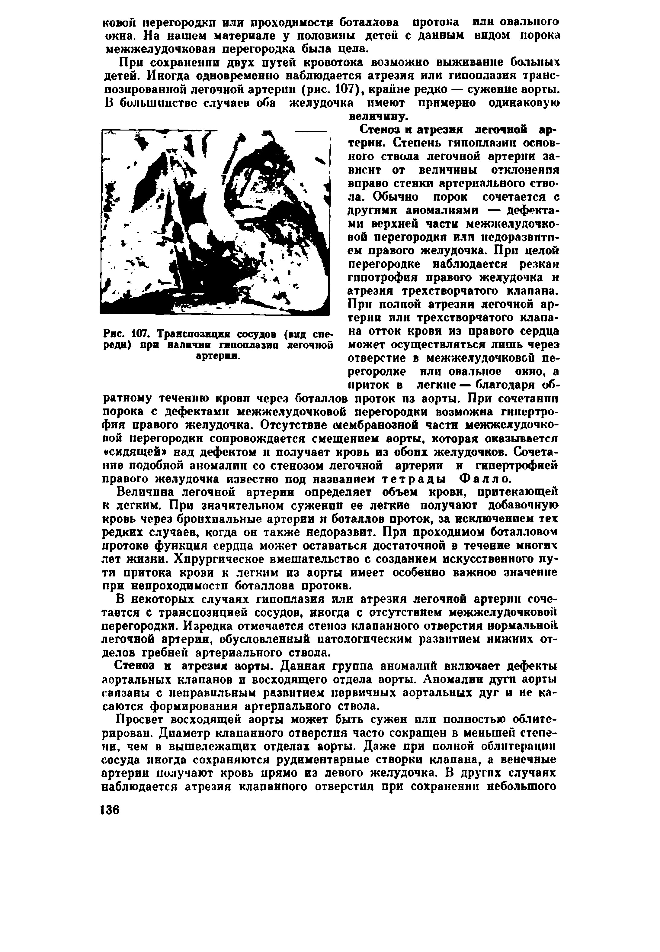 Рис. 107. Транспозиция сосудов (вид спереди) при валичин гипоплазии легочной артерии.