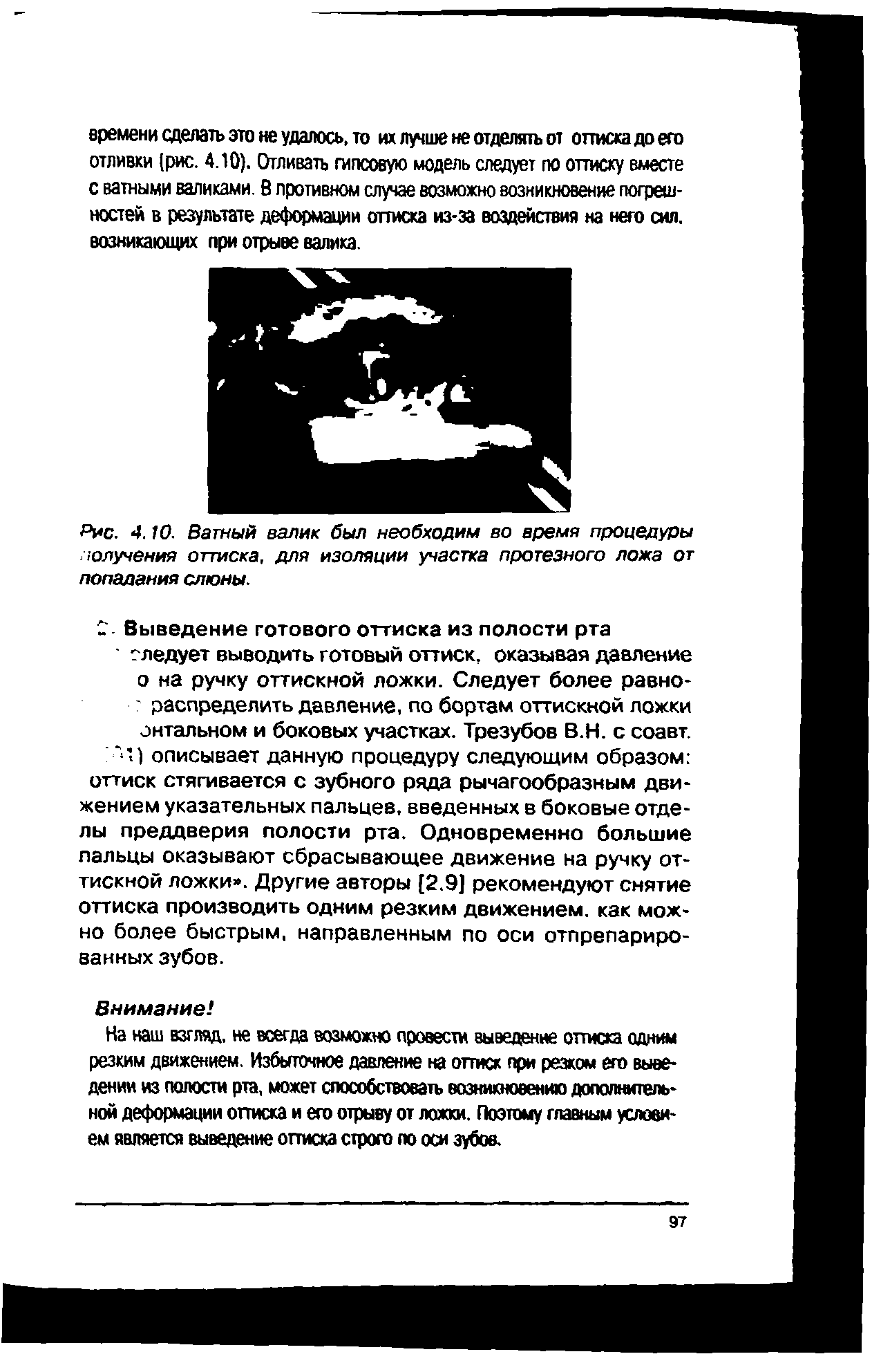 Рис. 4. ТО. Ватный валик был необходим во время процедуры получения оттиска, для изоляции участка протезного ложа от попадания слюны.