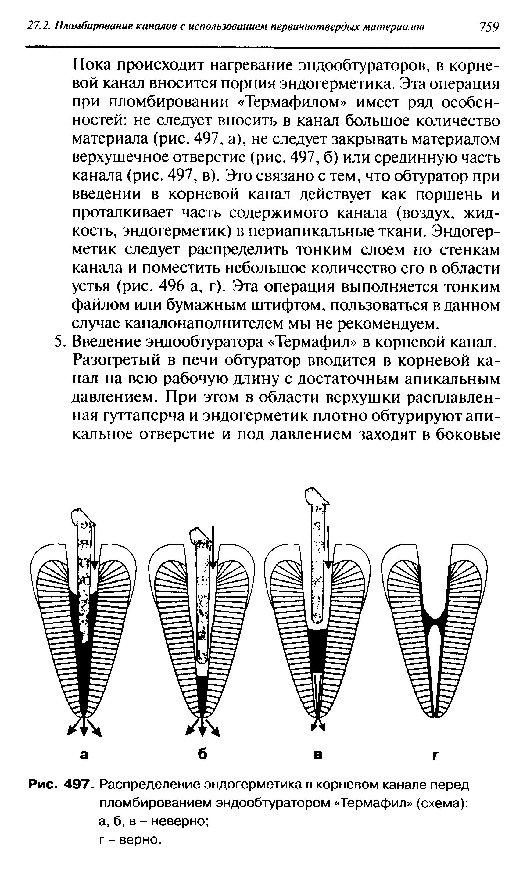 Рис. 497. Распределение эндогерметика в корневом канале перед пломбированием эндообтуратором Термафил (схема) а, б, в - неверно ...