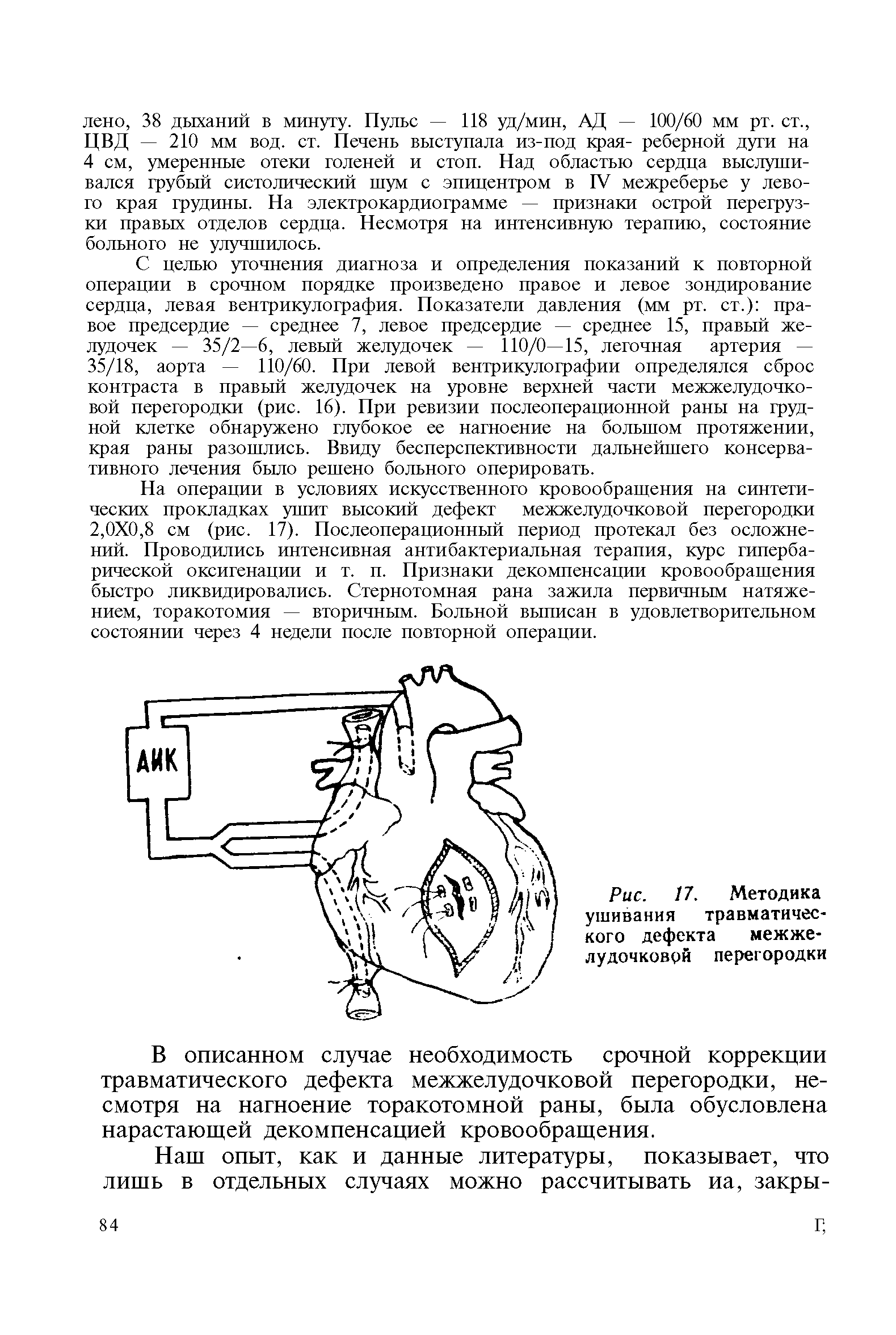 Рис. 17. Методика ушивания травматического дефекта межжелудочковой перегородки...