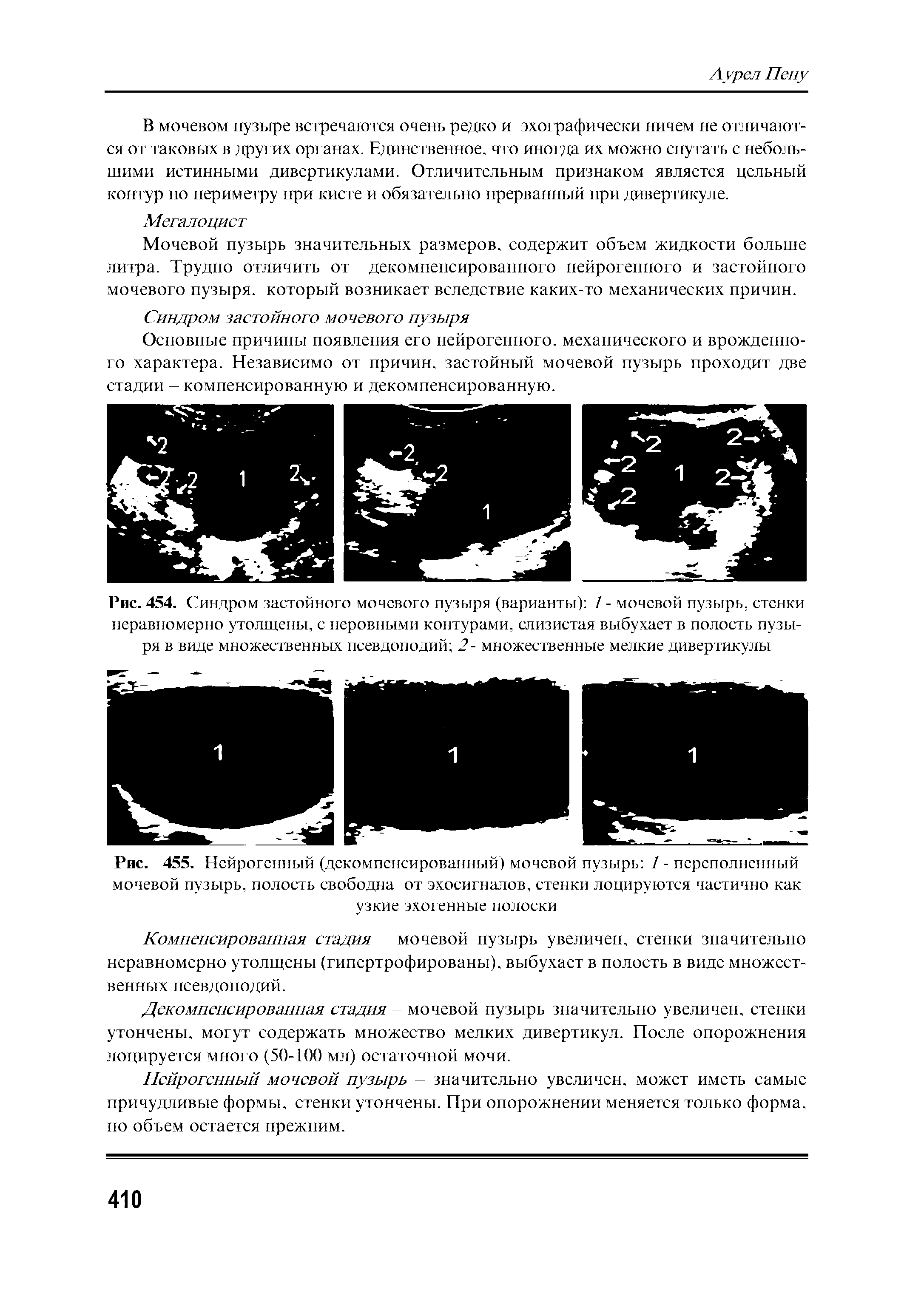 Рис. 454. Синдром застойного мочевого пузыря (варианты) 1 - мочевой пузырь, стенки неравномерно утолщены, с неровными контурами, слизистая выбухает в полость пузыря в виде множественных псевдоподий 2- множественные мелкие дивертикулы...
