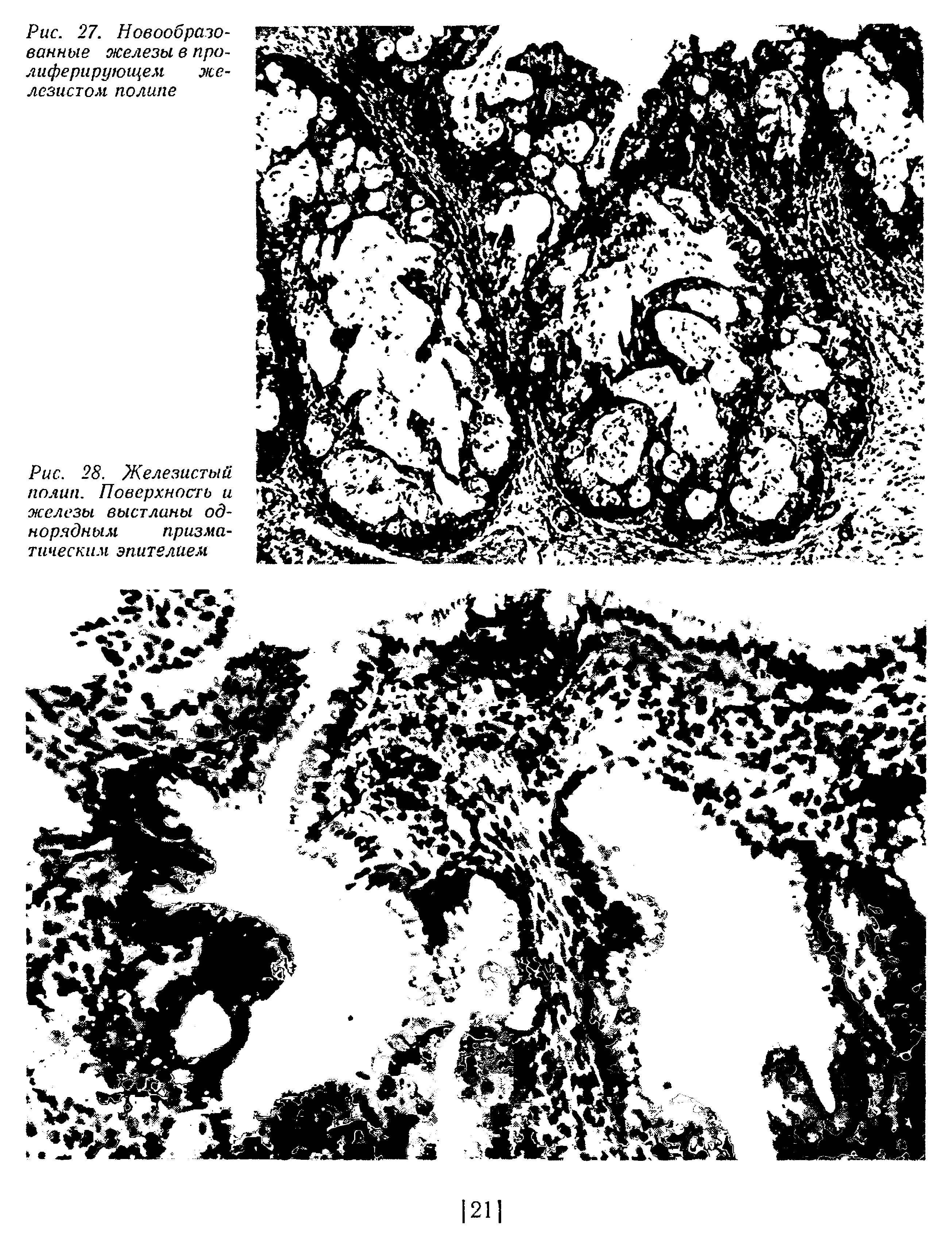 Рис. 28. Железистый полип. Поверхность и железы выстланы однорядным призматическим эпителием...