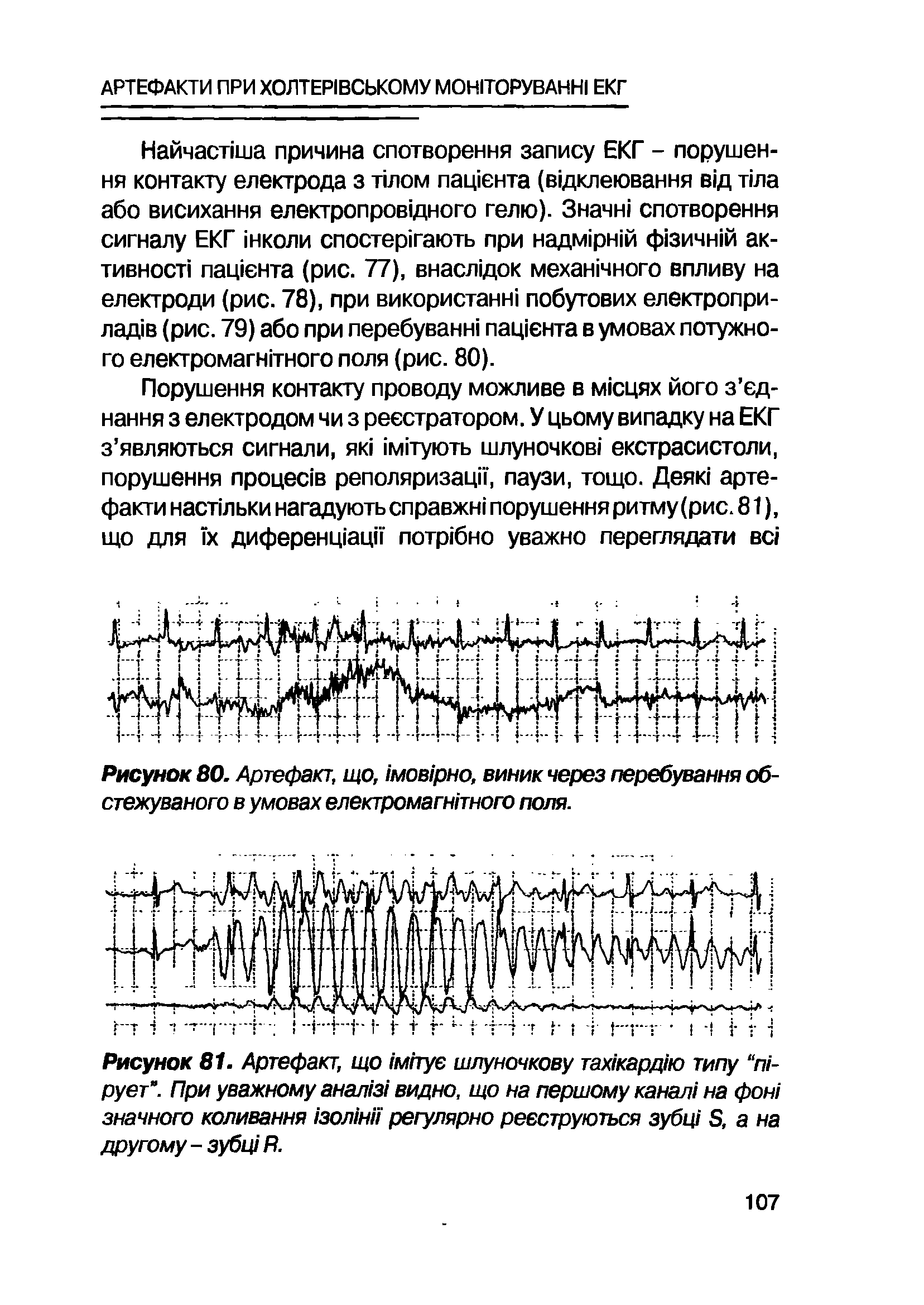 Рисунок 81. Артефакт, що м/туе шлуночкову тах/кардио типу пг рует". При уважному анал1з1 видно, що на першому канал1 на фон/ значного коливання зол1нп регулярно рееструються зубщ Б, а на другому - зубц/ Я.