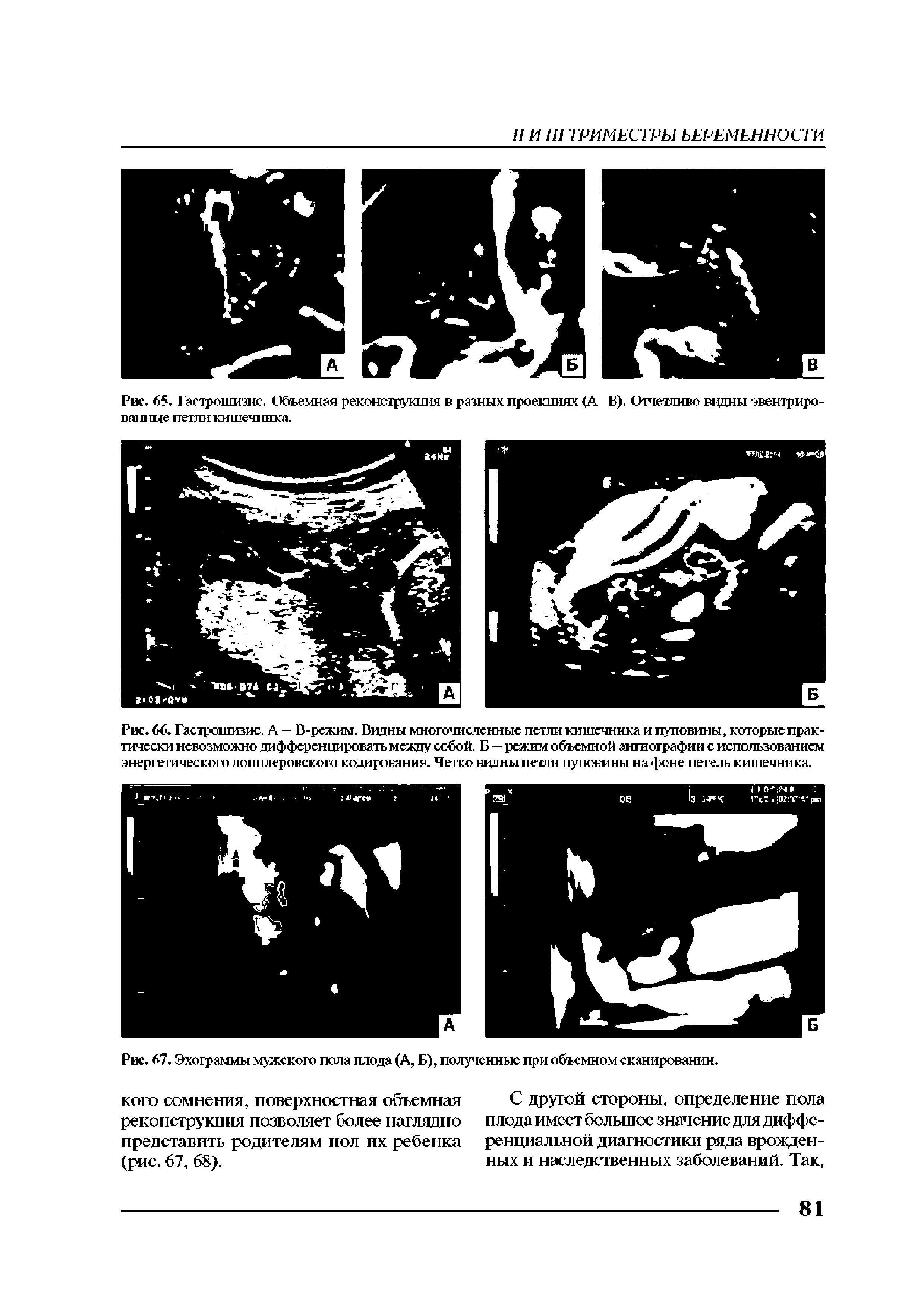 Рис. 67. Эхограммы мужского пола плода (А, Б), полученные при объемном сканировании.