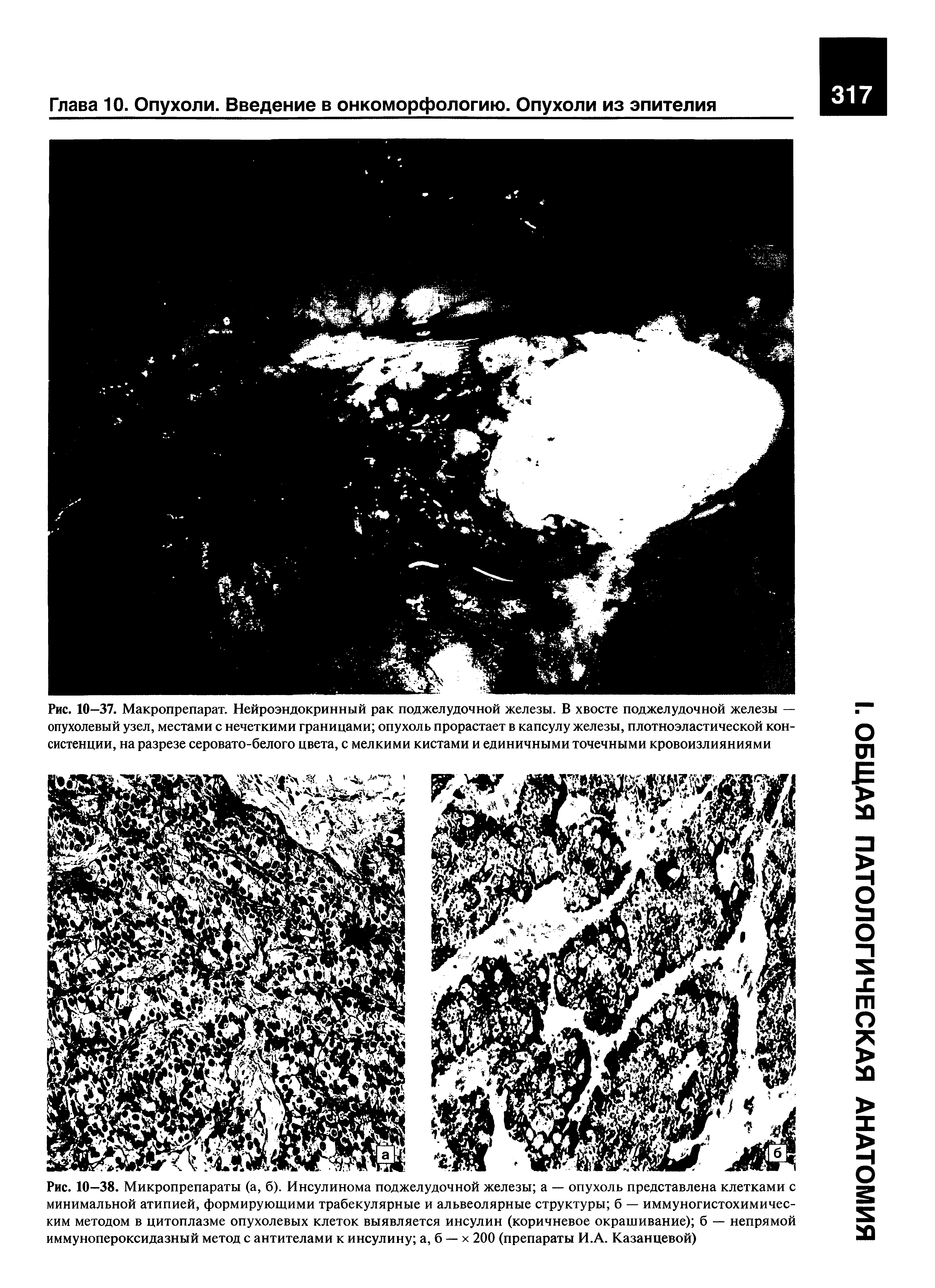 Рис. 10—38. Микропрепараты (а, б). Инсулинома поджелудочной железы а — опухоль представлена клетками с минимальной атипией, формирующими трабекулярные и альвеолярные структуры б — иммуногистохимическим методом в цитоплазме опухолевых клеток выявляется инсулин (коричневое окрашивание) б — непрямой иммунопероксидазный метод с антителами к инсулину а, б — х 200 (препараты И.А. Казанцевой)...