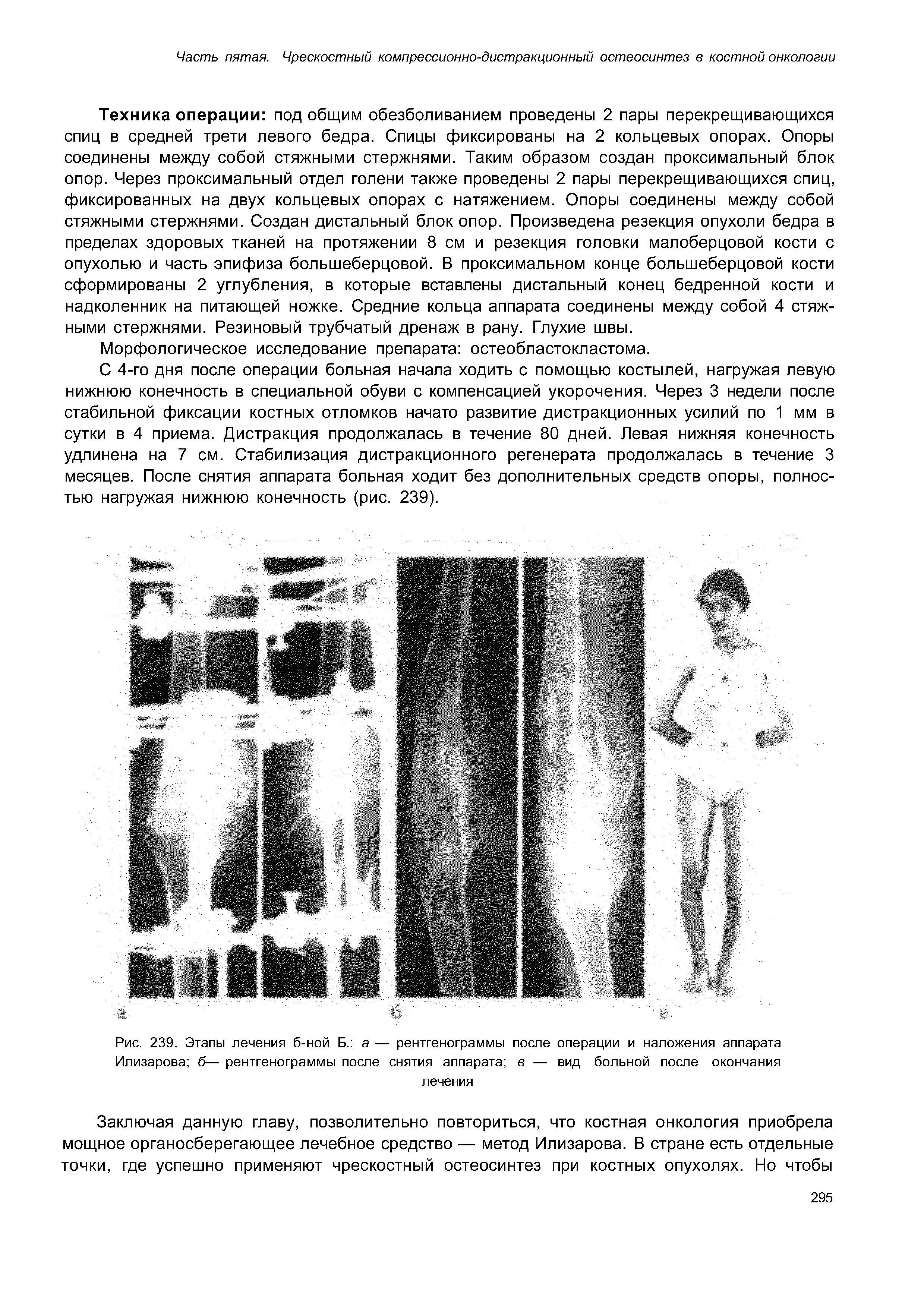 Рис. 239. Этапы лечения б-ной Б. а — рентгенограммы после операции и наложения аппарата Илизарова б— рентгенограммы после снятия аппарата в — вид больной после окончания лечения...