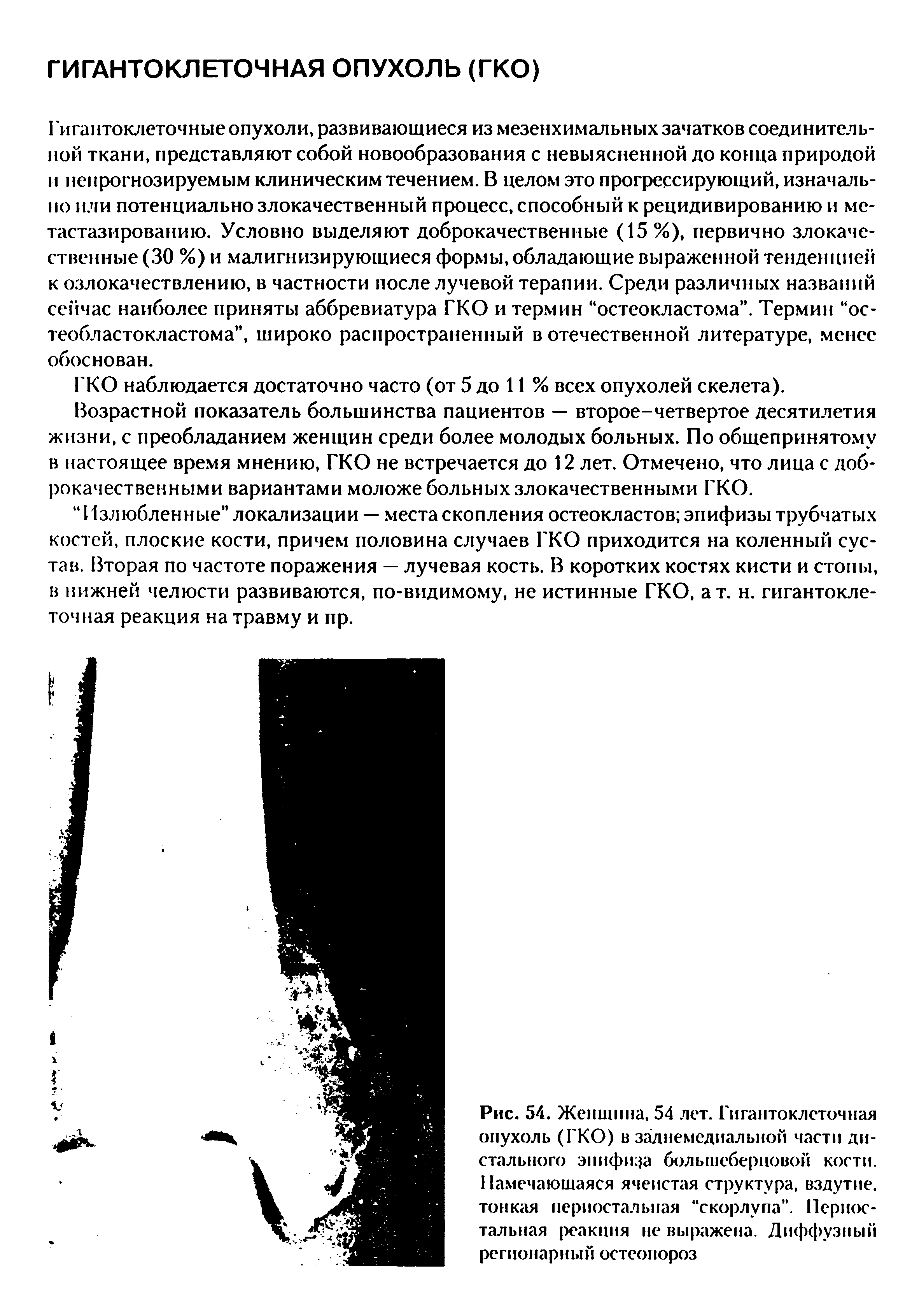 Рис. 54. Женщина, 54 лет. Гигантоклеточная опухоль (ГКО) в заднемедиальной части дистального эпифиза большеберцовой кости. Намечающаяся ячеистая структура, вздутие, тонкая периостальная скорлупа . Периостальная реакция не выражена. Диффузный регионарный остеопороз...