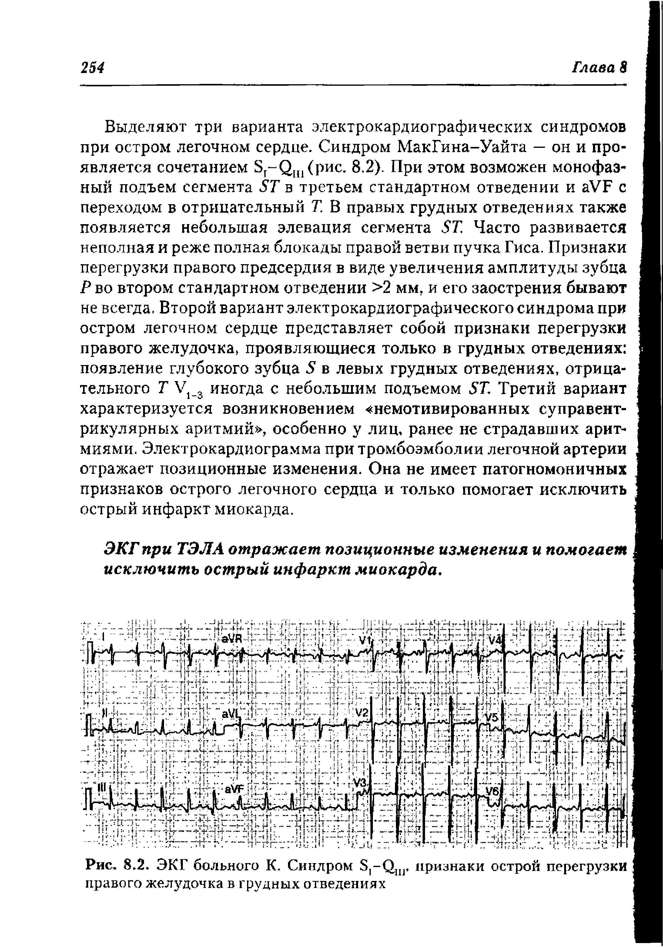 Рис. 8.2. ЭКГ больного К. Синдром 8(-С)пг признаки острой перегрузки правого желудочка в грудных отведениях...