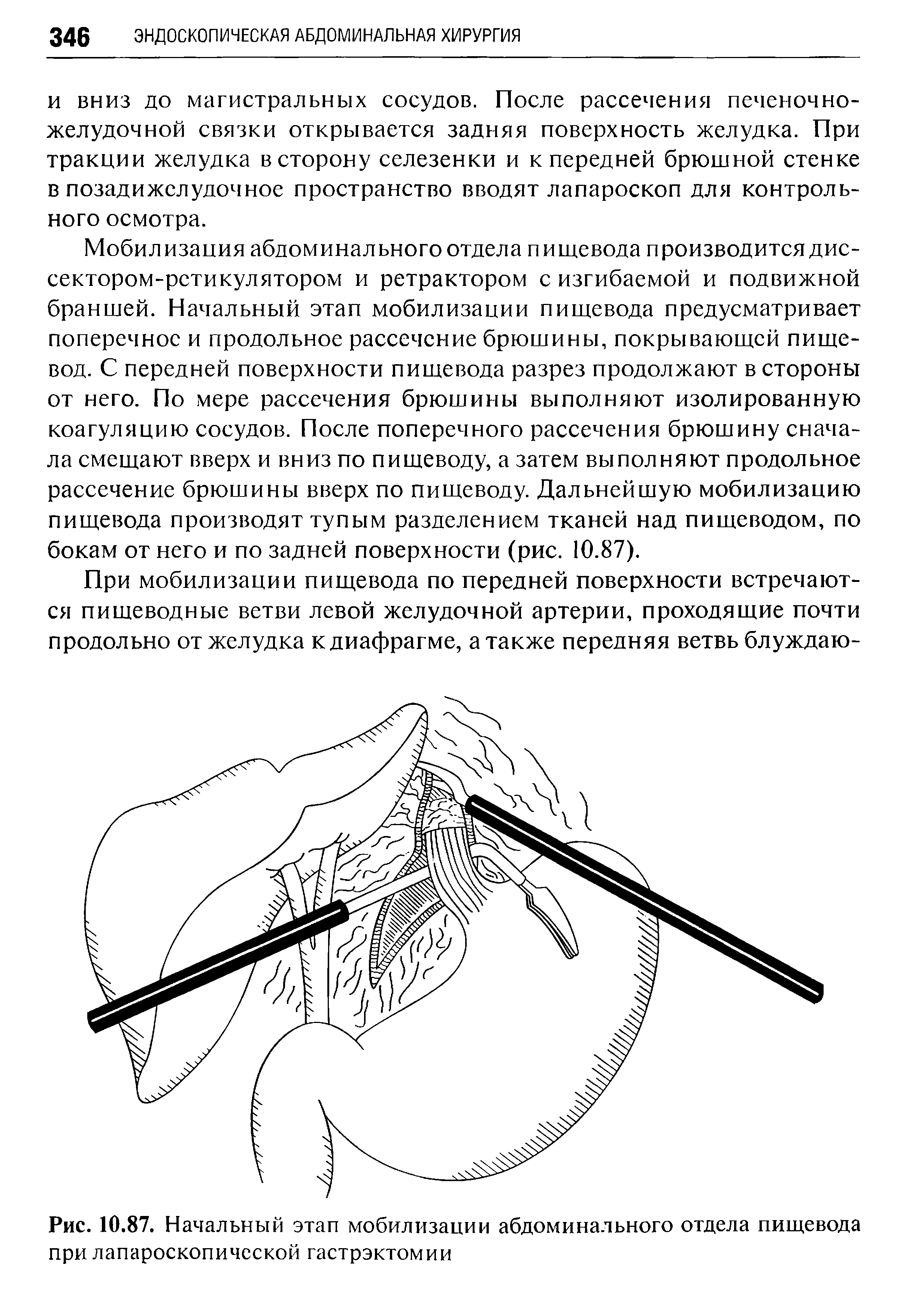 Рис. 10.87. Начальный этап мобилизации абдоминального отдела пищевода при лапароскопической гастрэктомии...