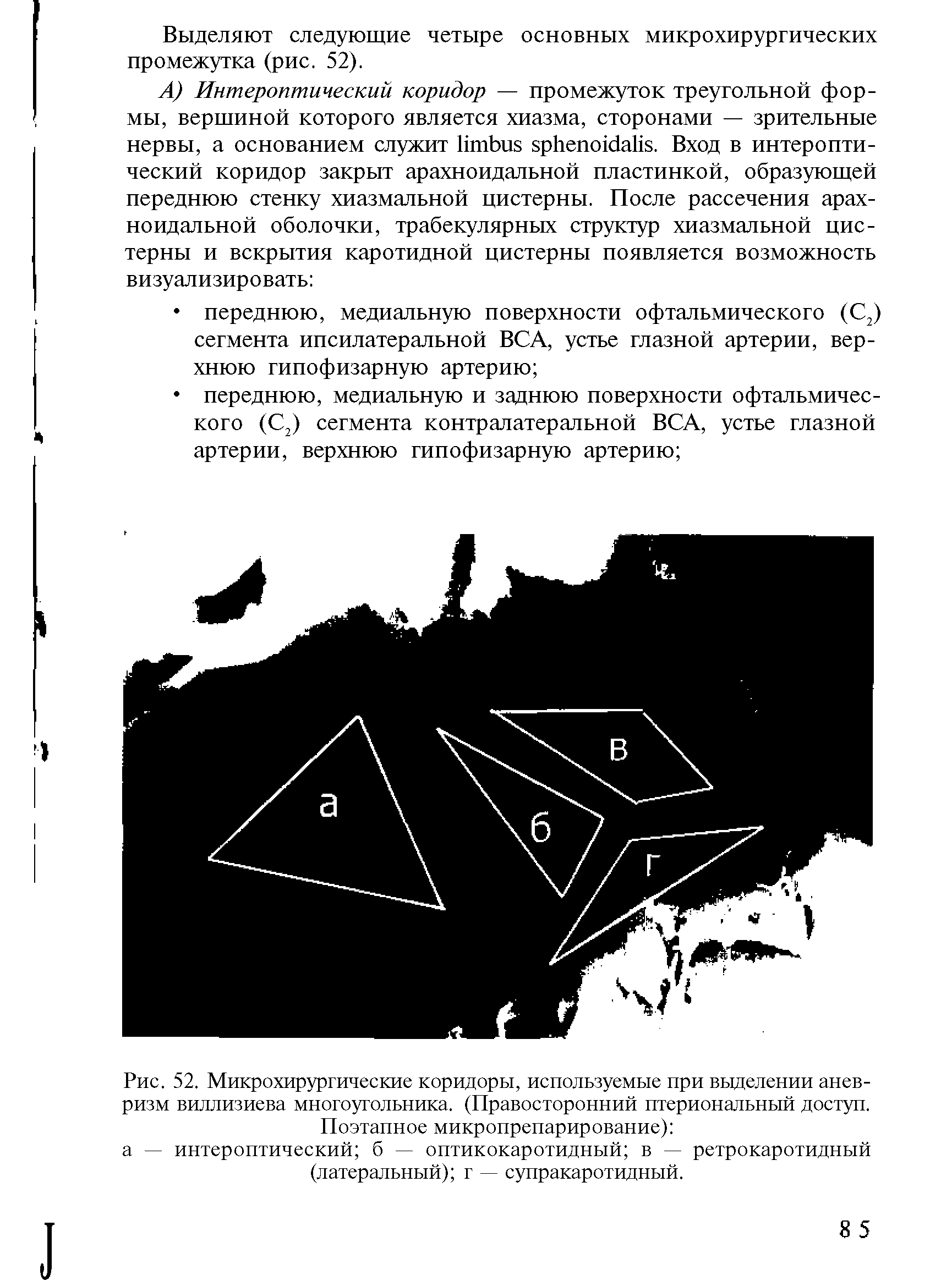 Рис. 52. Микрохирургические коридоры, используемые при выделении аневризм виллизиева многоугольника. (Правосторонний птериональный доступ.