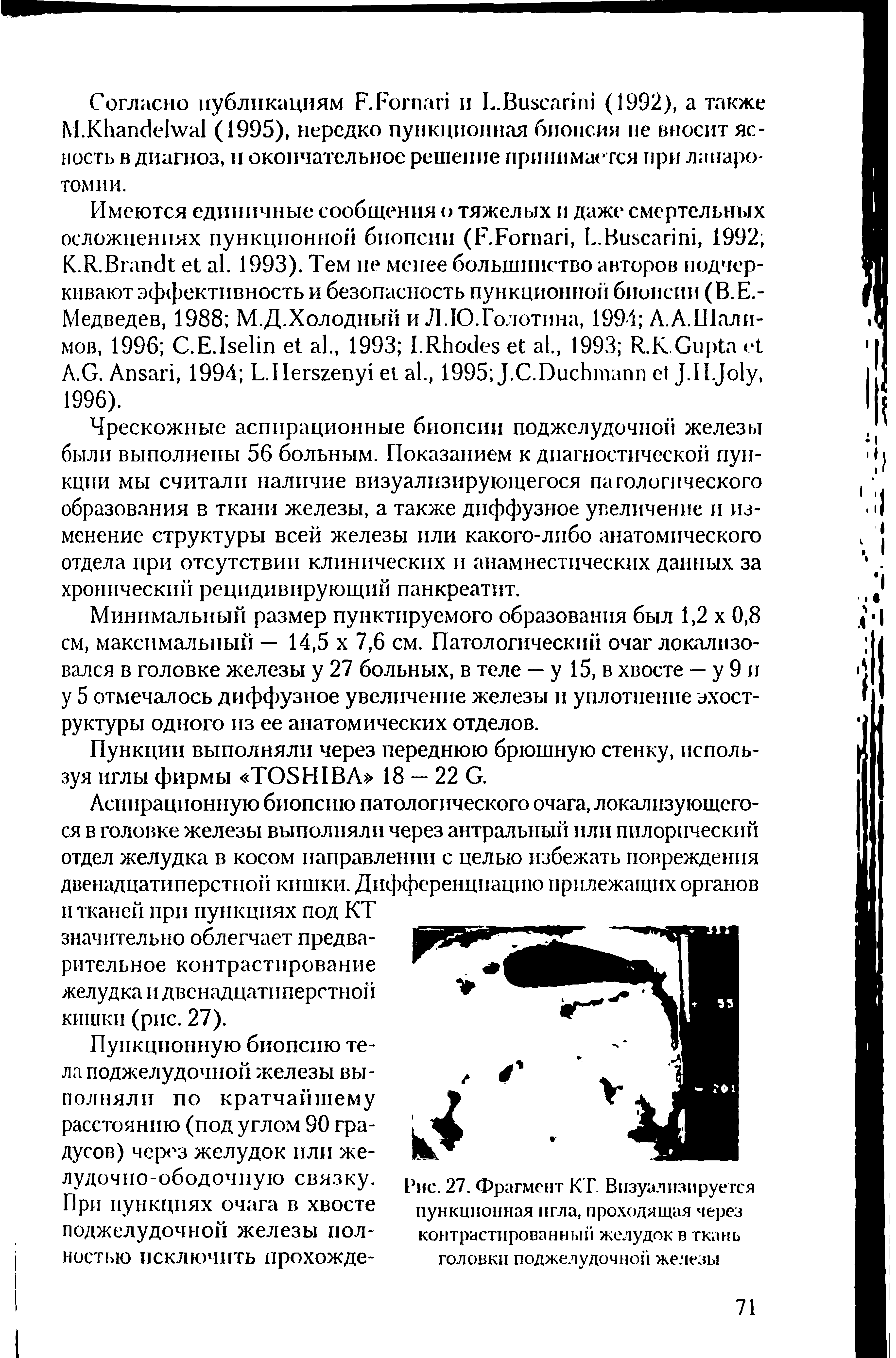 Рис. 27. Фрагмент К Г. Визуализируется пункционная игла, проходящая через контрастированный желудок в ткань головки поджелудочной железы...