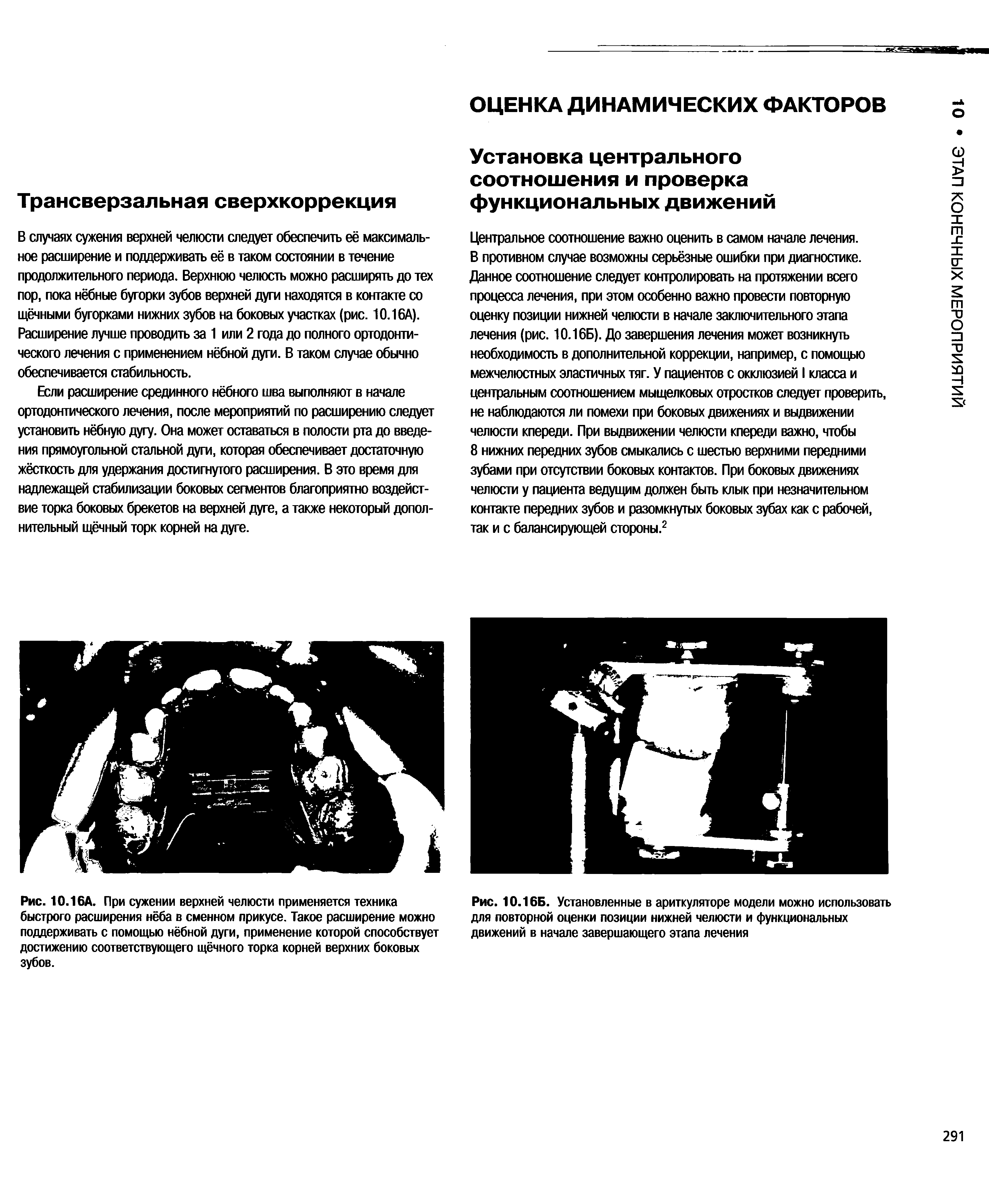 Рис. 10.16А. При сужении верхней челюсти применяется техника быстрого расширения нёба в сменном прикусе. Такое расширение можно поддерживать с помощью нёбной дуги, применение которой способствует достижению соответствующего щёчного торка корней верхних боковых зубов.