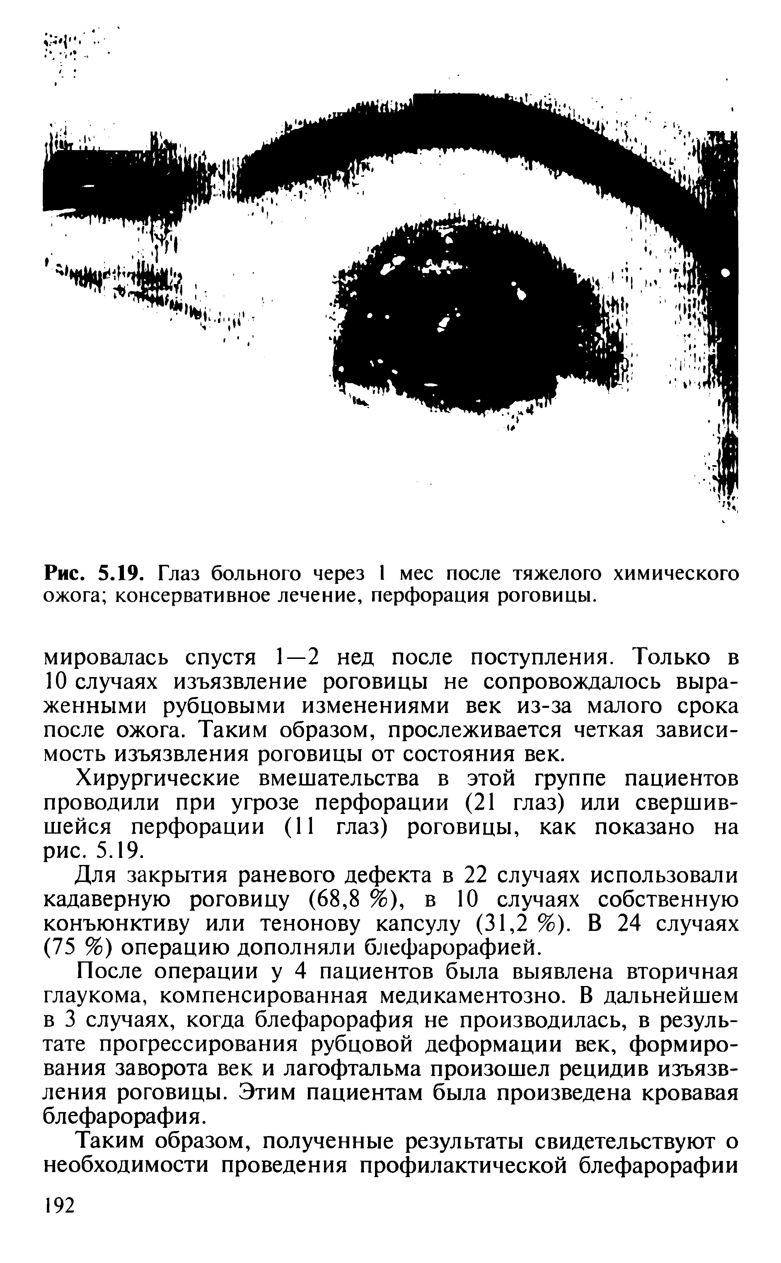 Рис. 5.19. Глаз больного через 1 мес после тяжелого химического ожога консервативное лечение, перфорация роговицы.