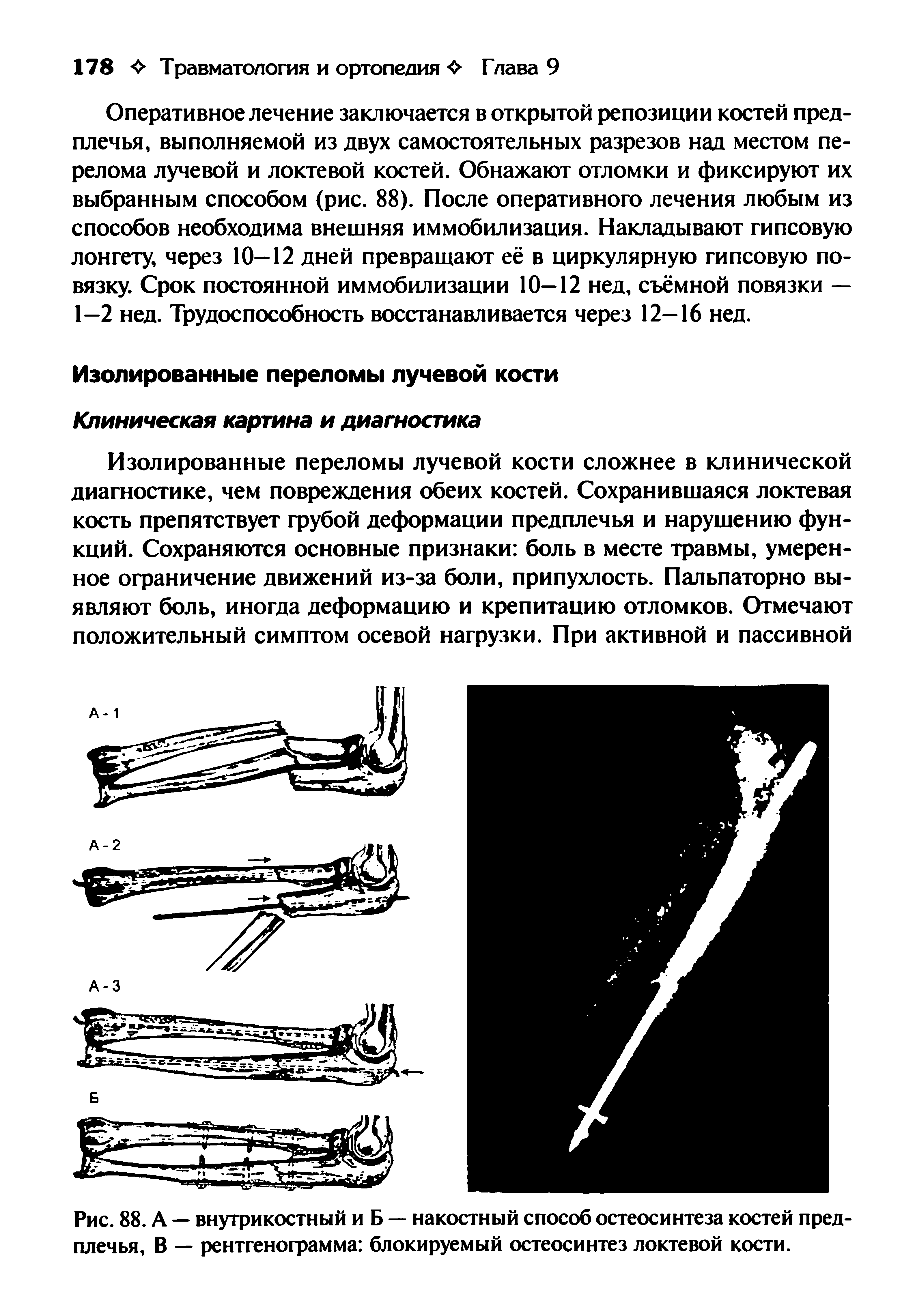 Рис. 88. А — внутрикостный и Б — накостный способ остеосинтеза костей предплечья, В — рентгенограмма блокируемый остеосинтез локтевой кости.