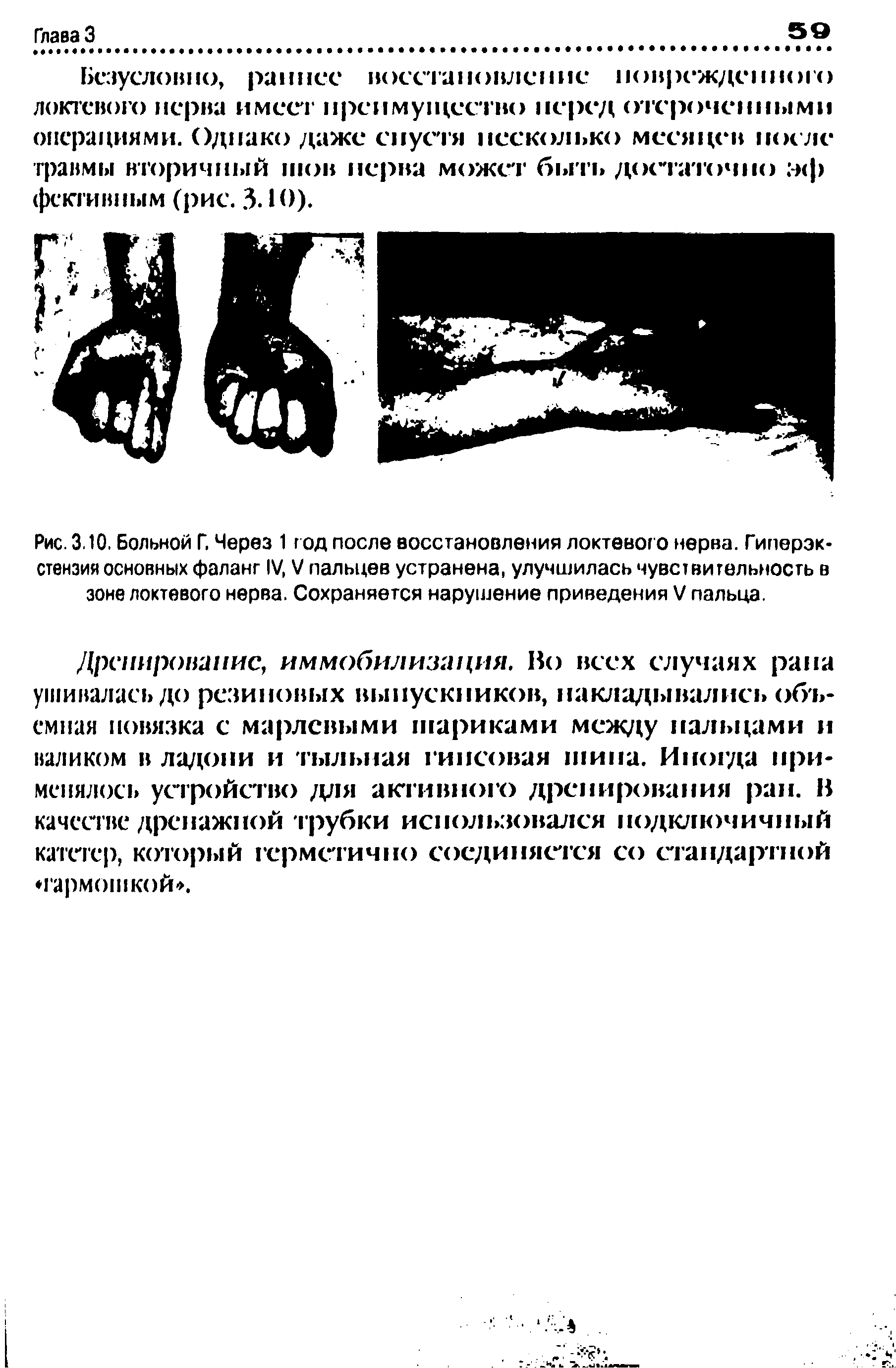 Рис. 3.10. Больной Г. Через 1 год после восстановления локтевого нерва. Гиперэкстензия основных фаланг IV, V пальцев устранена, улучшилась чувствительность в зоне локтевого нерва. Сохраняется нарушение приведения V пальца.