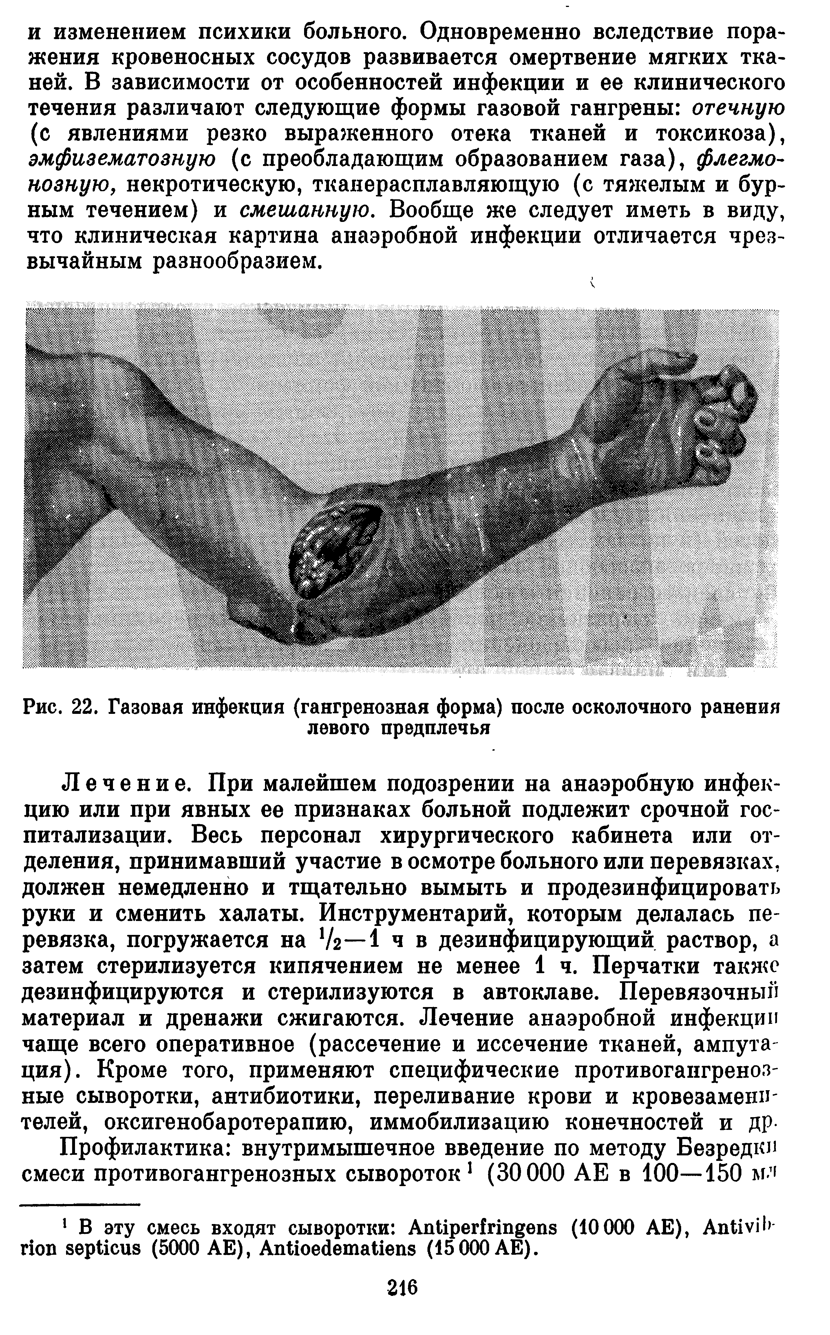 Рис. 22. Газовая инфекция (гангренозная форма) после осколочного ранения левого предплечья...