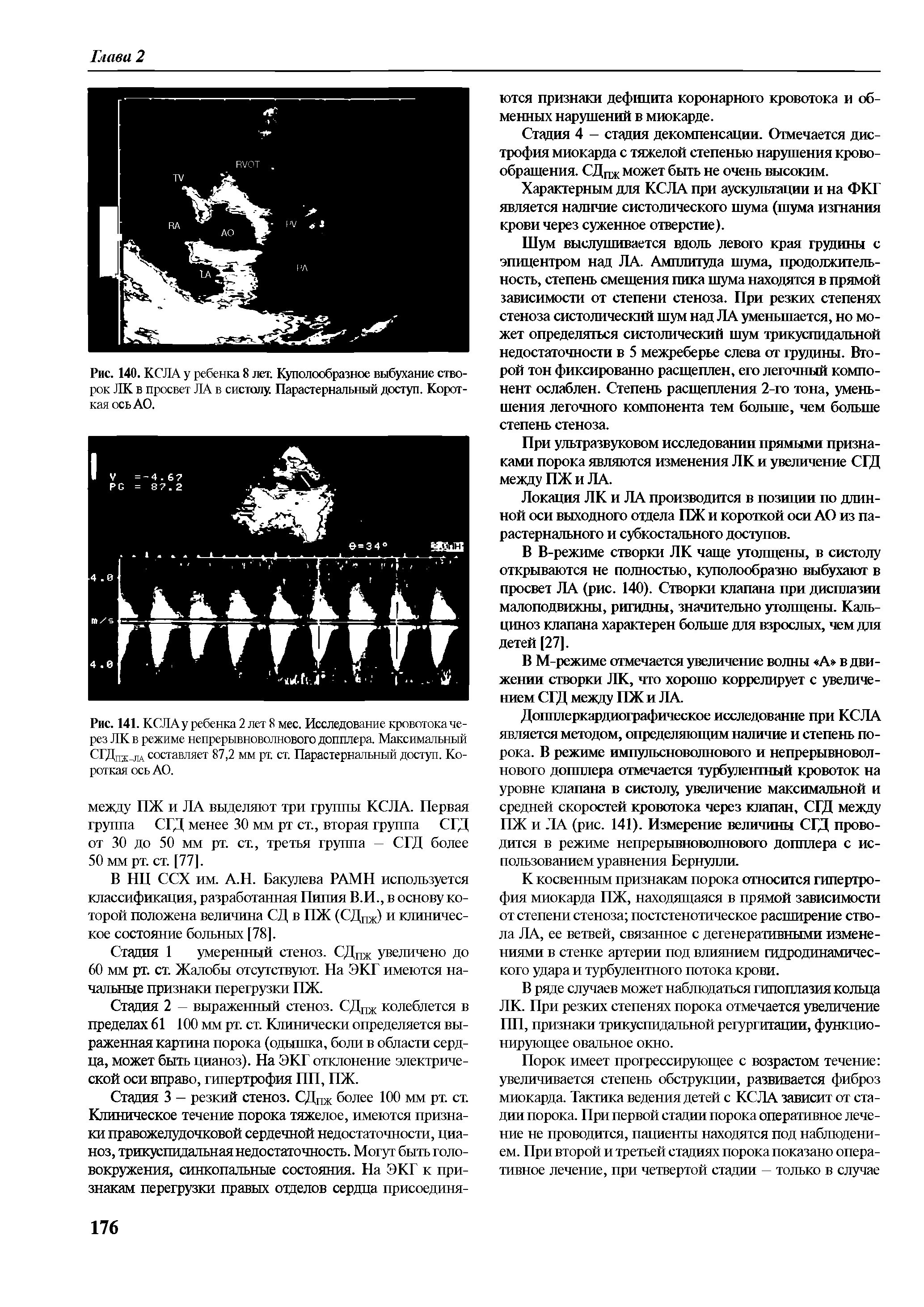 Рис. 141. КСЛА у ребенка 2 лет 8 мес. Исследование кровотока через ЛК в режиме непрерывноволнового допплера. Максимальный сгдпж ж составляет 87,2 мм рт. ст. Парастернальный доступ. Короткая ось АО.