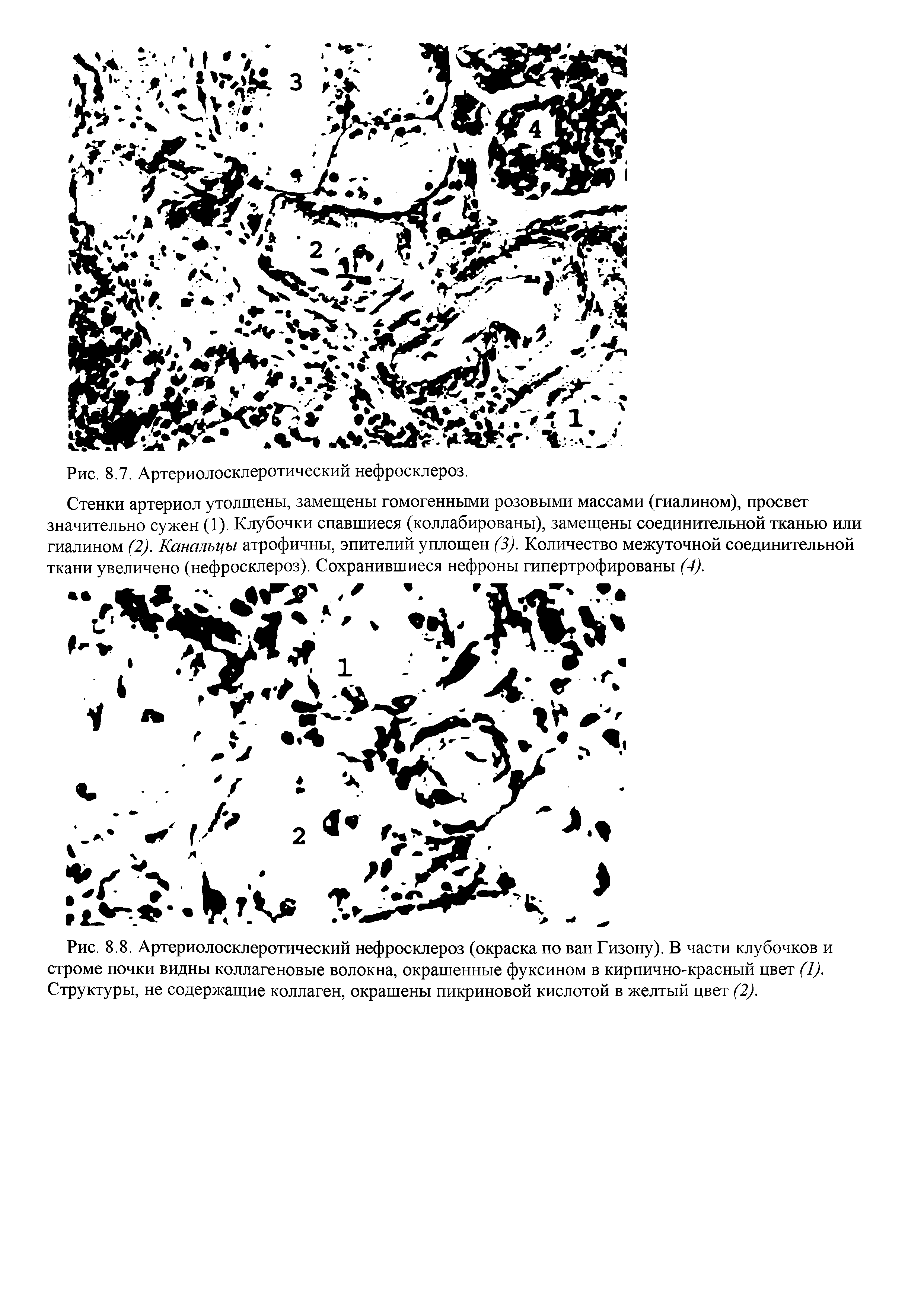 Рис. 8.8. Артериолосклеротический нефросклероз (окраска по ван Гизону). В части клубочков и строме почки видны коллагеновые волокна, окрашенные фуксином в кирпично-красный цвет (1). Структуры, не содержащие коллаген, окрашены пикриновой кислотой в желтый цвет (2).