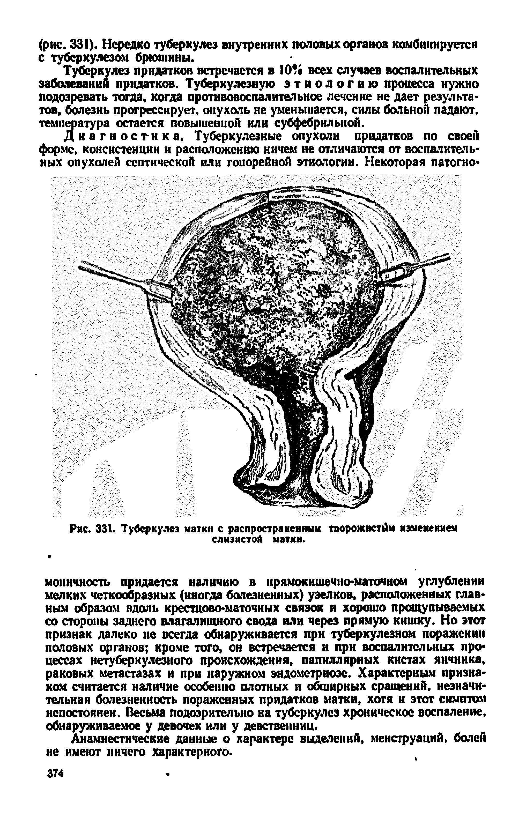 Рис. 331. Туберкулез матки с распространенным творожистом изменением слизистой матки.