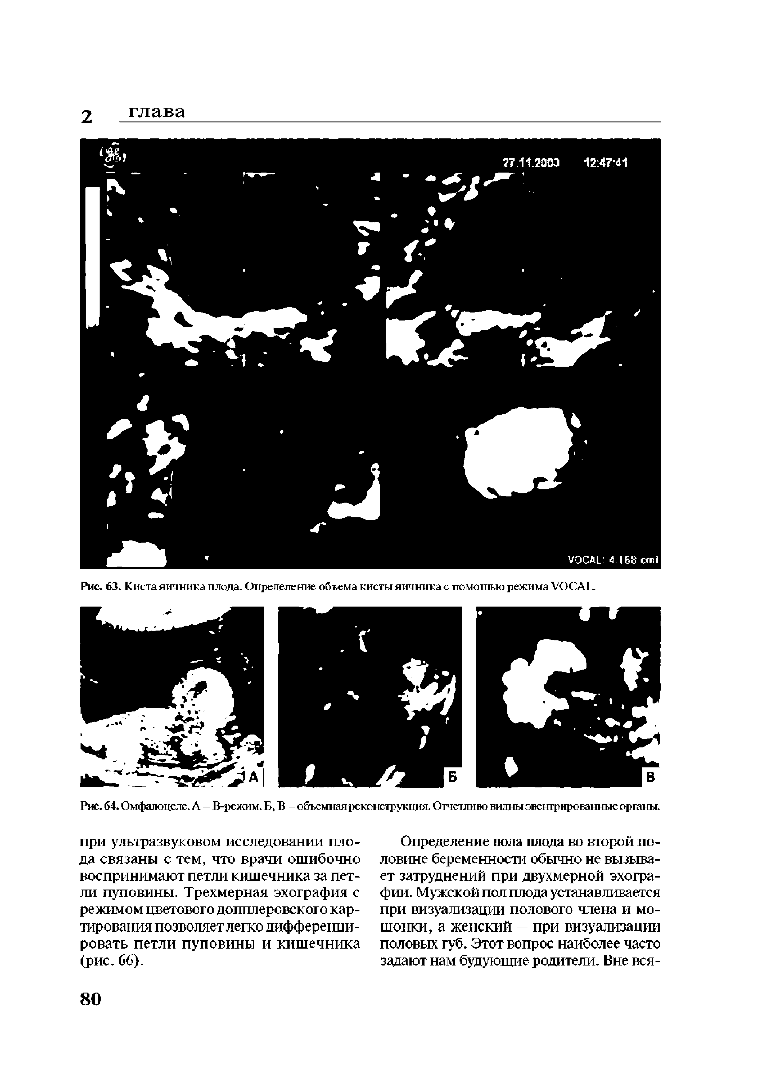 Рис. 63. Киста яичника плода. Определение объема кисты яичника с помощью режима VOCAL.