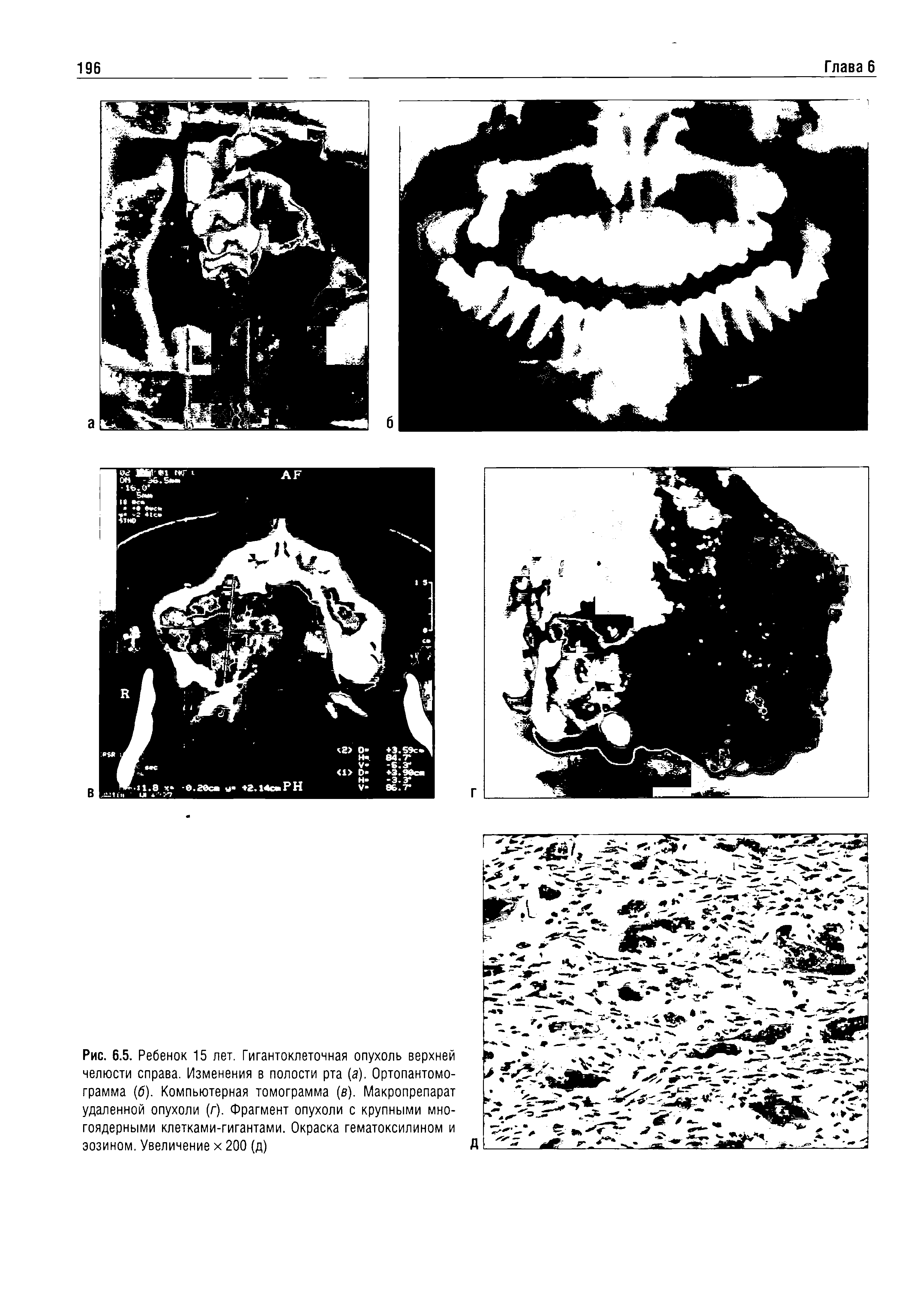 Рис. 6.5. Ребенок 15 лет. Гигантоклеточная опухоль верхней челюсти справа. Изменения в полости рта (а). Ортопантомограмма (б). Компьютерная томограмма (в). Макропрепарат удаленной опухоли (г). Фрагмент опухоли с крупными многоядерными клетками-гигантами. Окраска гематоксилином и эозином. Увеличение х 200 (д)...