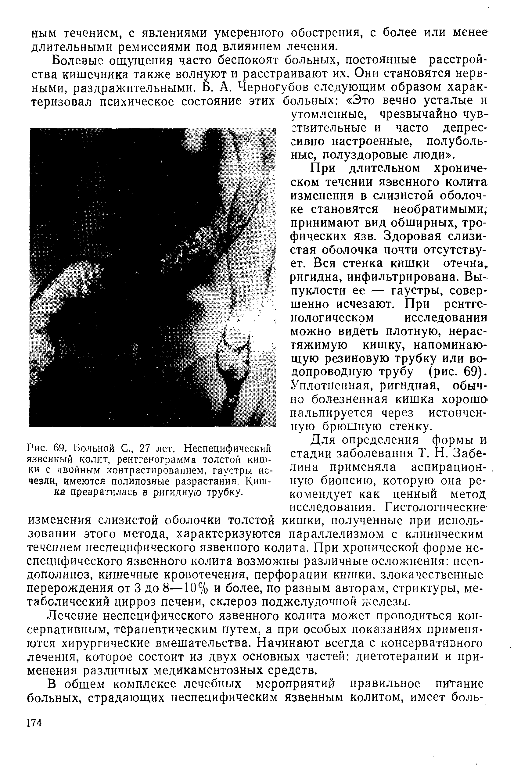 Рис. 69. Больной С., 27 лет. Неспеиифическпй язвенный колит, рентгенограмма толстой кишки с двойным контрастированием, гаустры исчезли, имеются полипозные разрастания. Кишка превратилась в ригидную трубку.