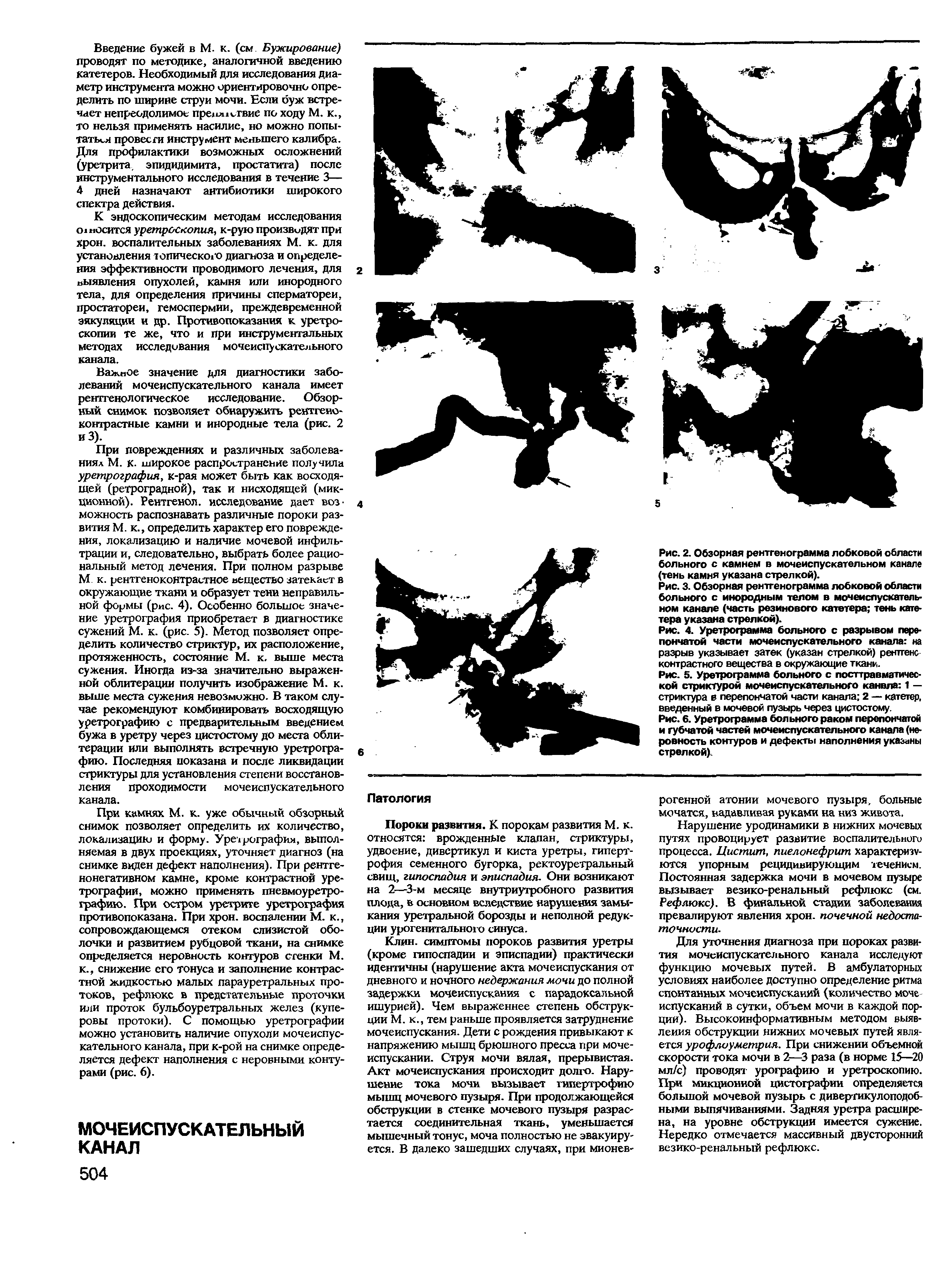 Рис. 3. Обзорная рентгенограмма лобковой области больного с инородным телом в мочеиспускательном канале (часть резинового катетера тень катетера указана стрелкой).