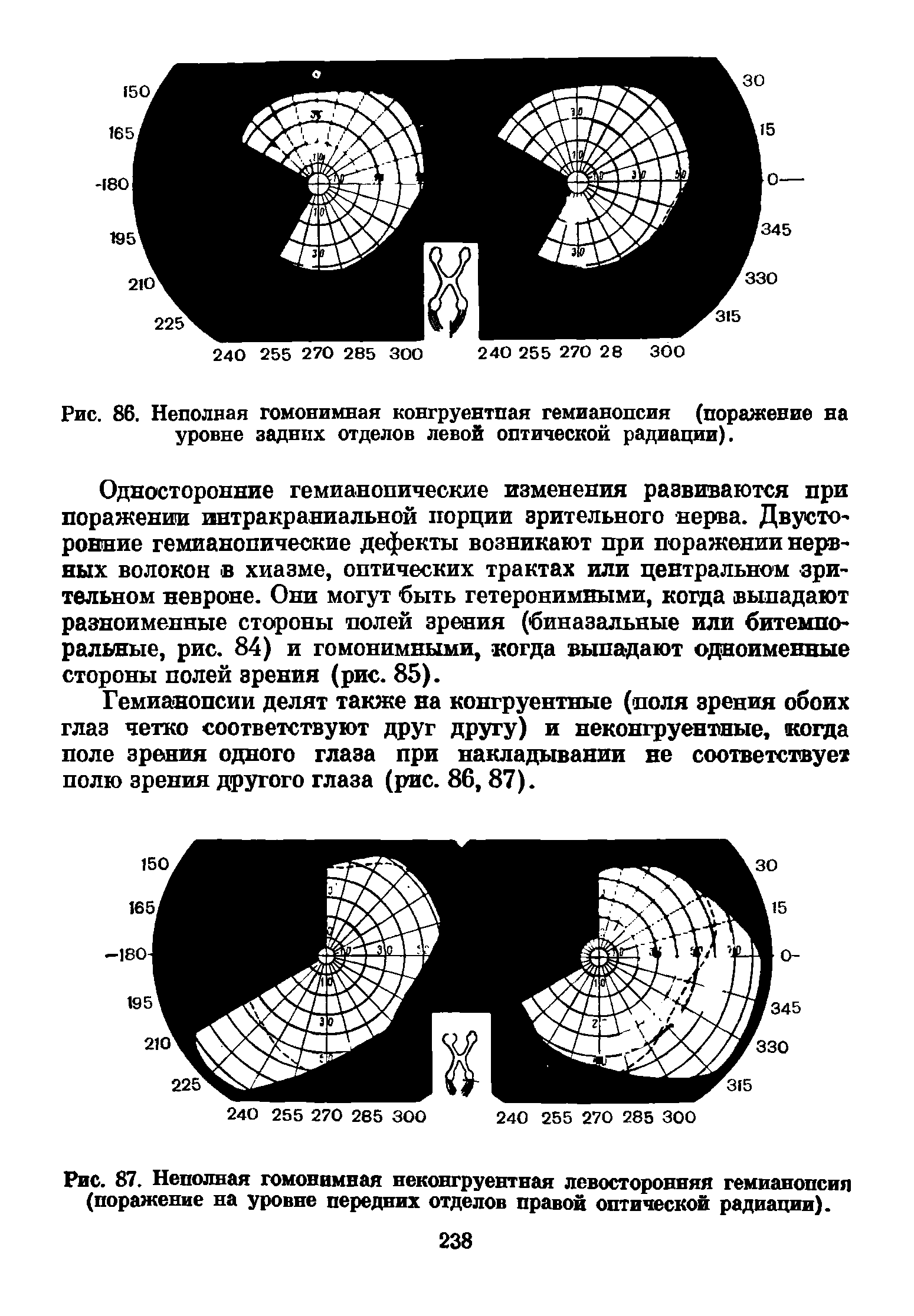 Рис. 86. Неполная гомонимная конгруентпая гемианопсия (поражение на уровне задних отделов левой оптической радиации).