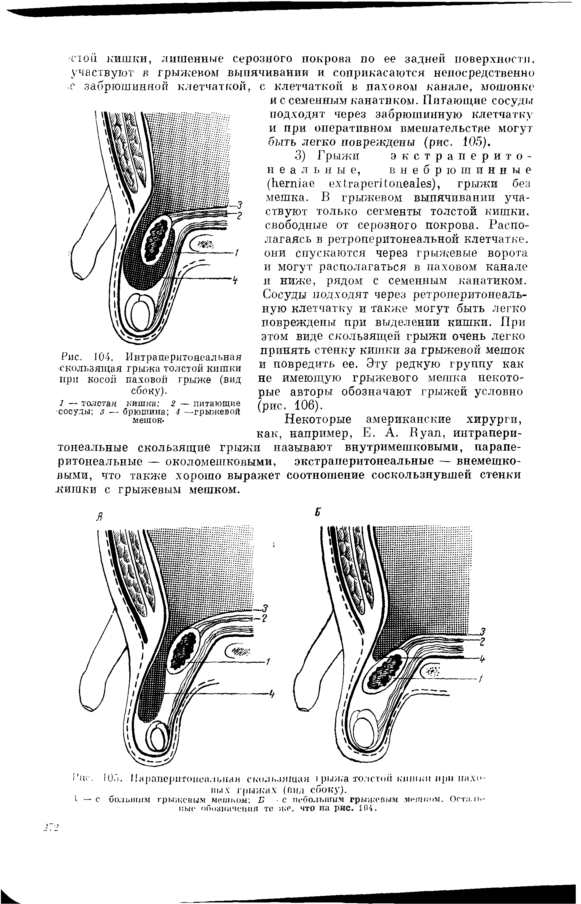 Рис. 104. Интраперитонеальная скользящая грыжа толстой кишки при косой паховой грыже (вид сбоку).