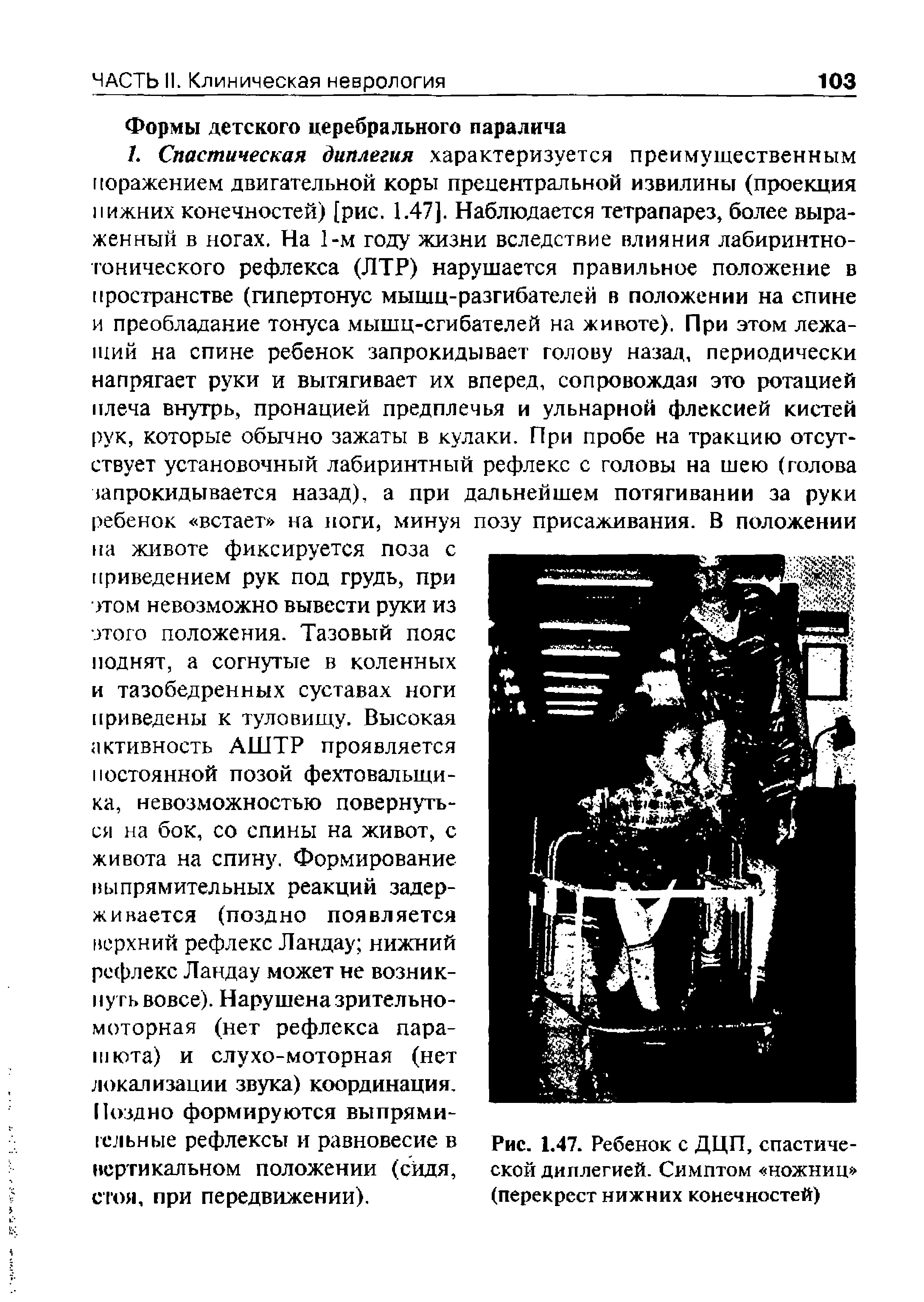 Рис. 1.47. Ребенок с ДЦП, спастической диплегией. Симптом ножниц (перекрест нижних конечностей)...