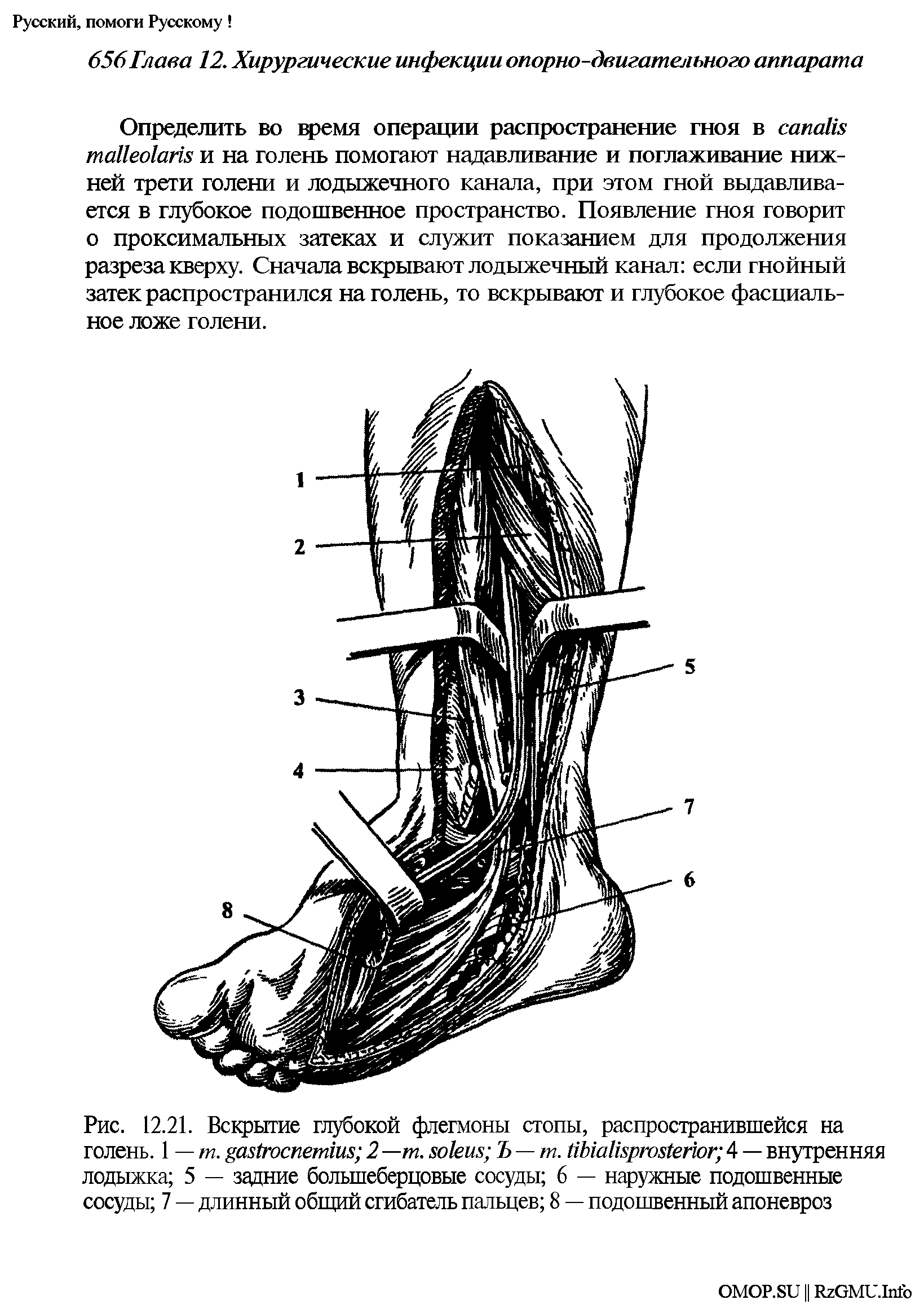 Рис. 12.21. Вскрытие глубокой флегмоны стопы, распространившейся на голень. 1 — т. 2 —т. Ъ — т. 4 — внутренняя лодыжка 5 — задние большеберцовые сосуды 6 — наружные подошвенные сосуды 7 — длинный общий сгибатель пальцев 8 — подошвенный апоневроз...
