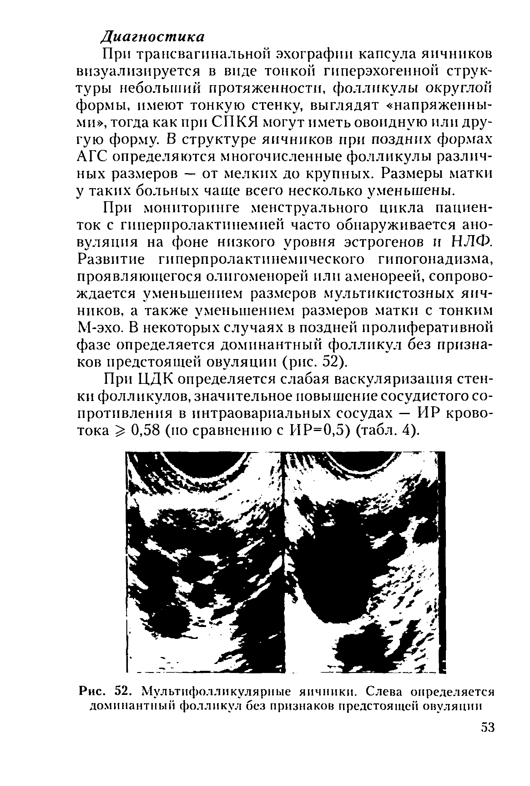 Рис. 52. Мультифолликулярные яичники. Слева определяется доминантный фолликул без признаков предстоящей овуляции...