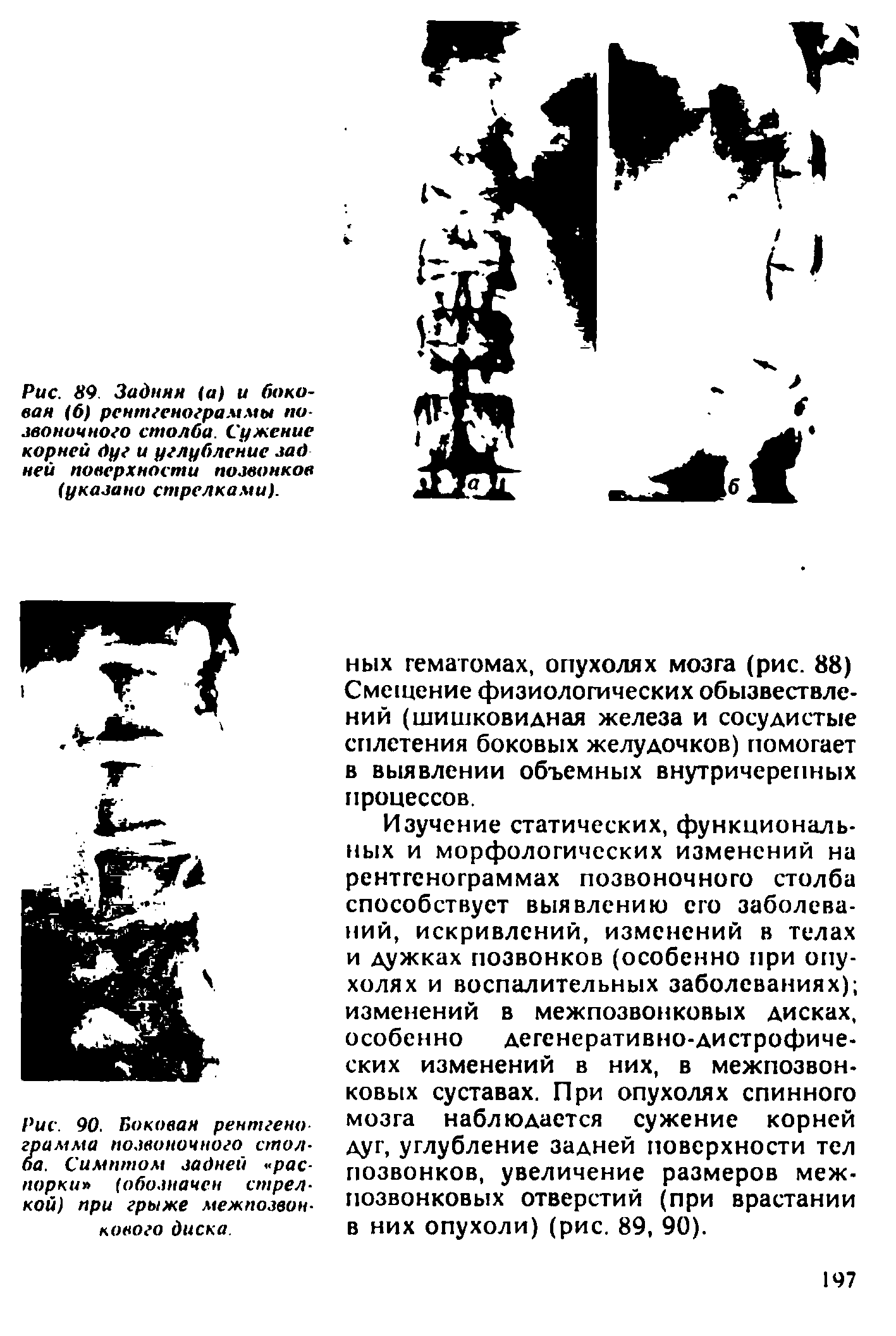 Рис. 90. Боковая рентгена грамма позвоночного столба. Симптом задней -распорки (обозначен стрелкой) при грыже межпозвонкового диска.