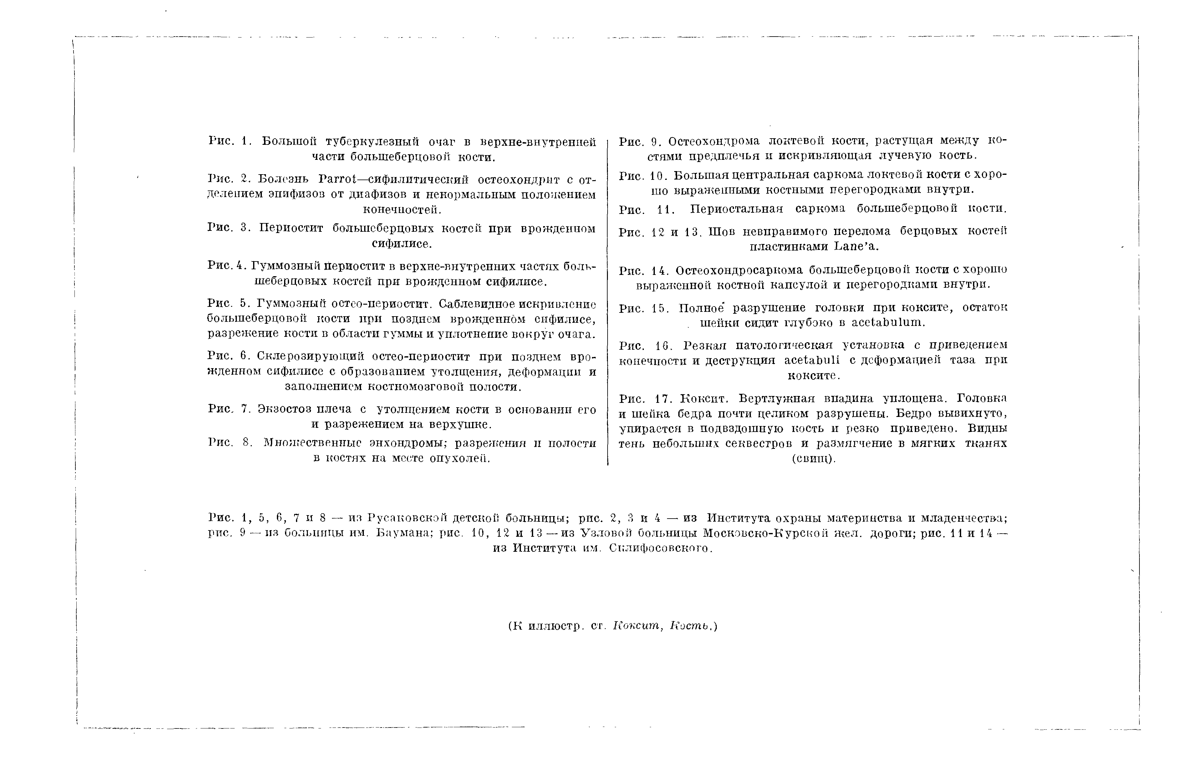 Рис. 8. Множественные энхондромы разрежения и полости в костях на месте опухолей.