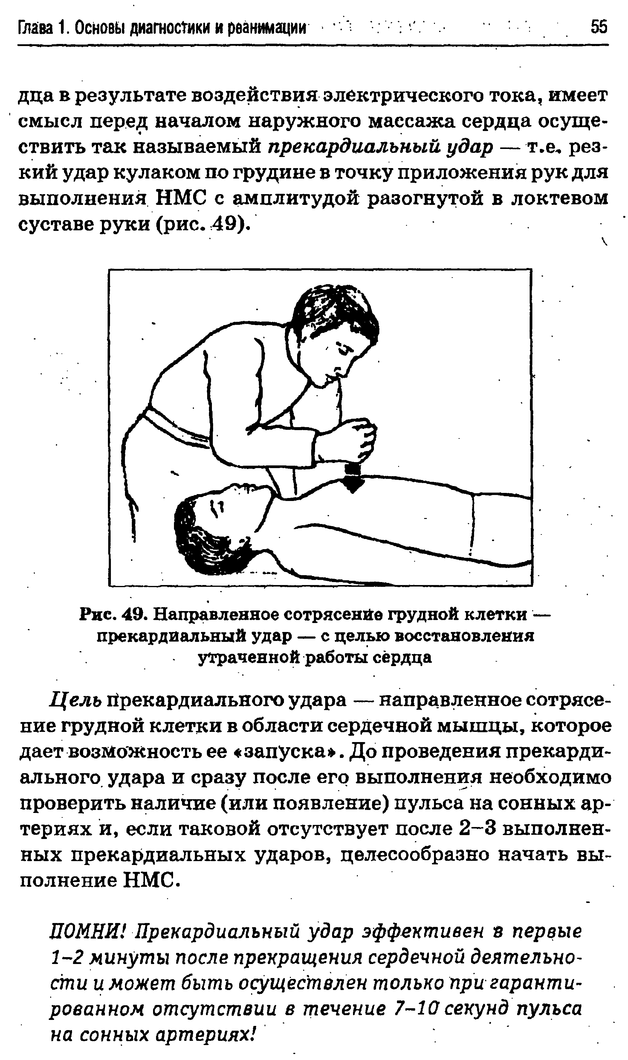 Рис. 49. Направленное сотрясение грудной клетки — прекардиальный удар — с целью восстановления утраченной работы сердца...