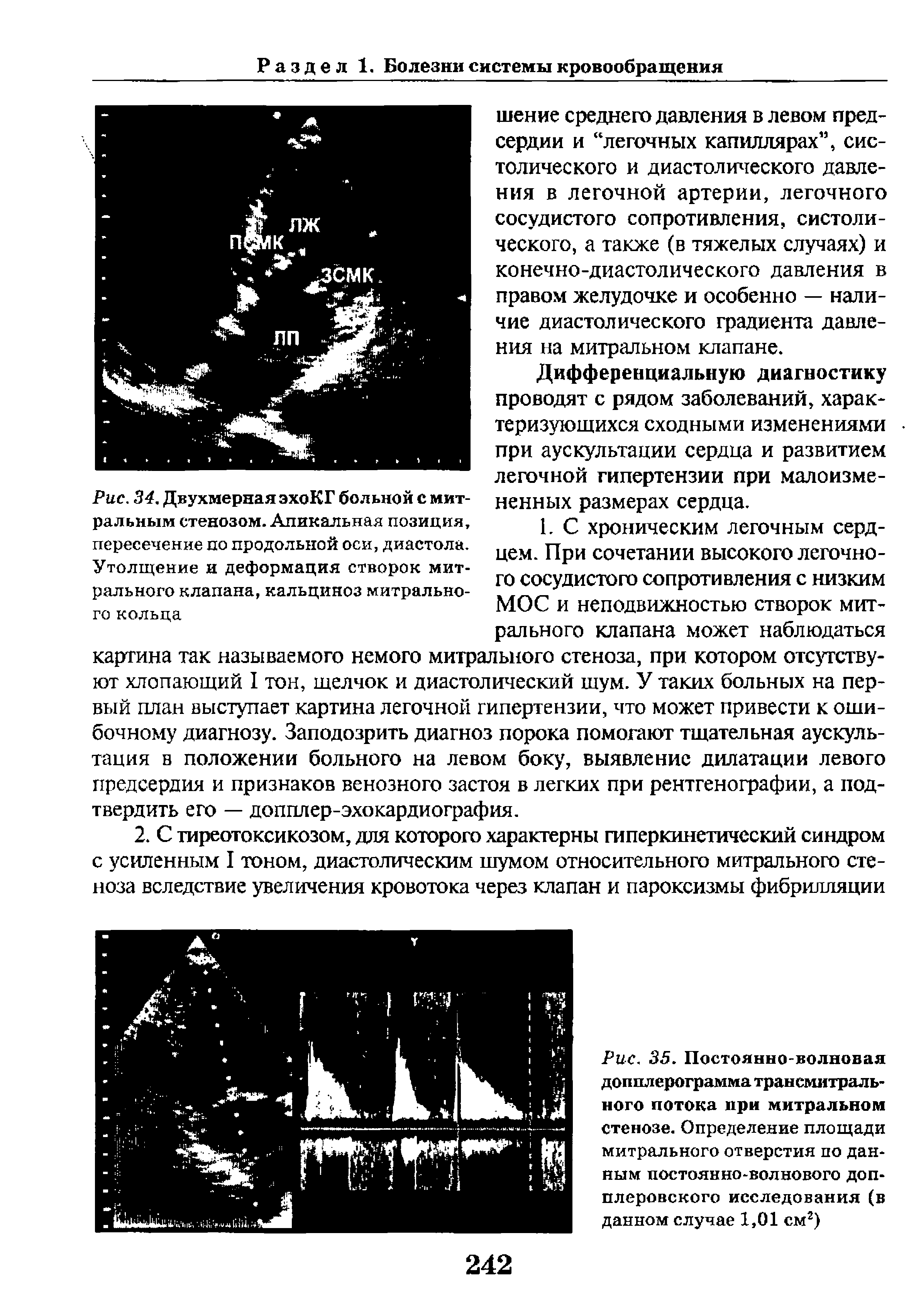 Рис. 34. Двухмерная эхоКГ больной с митральным стенозом. Апикальная позиция, пересечение по продольной оси, диастола. Утолщение и деформация створок митрального клапана, кальциноз митрального кольца...