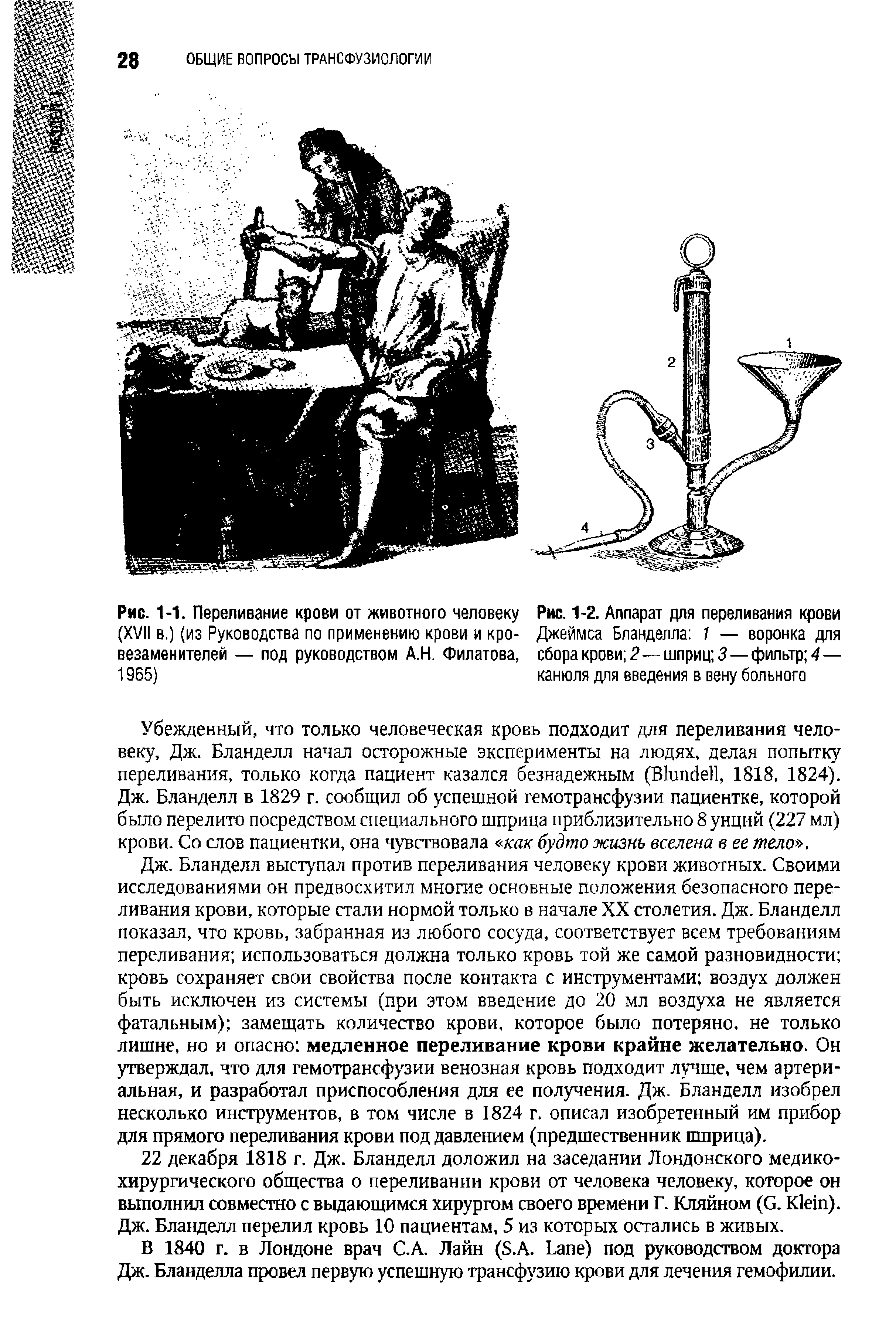 Рис. 1-2. Аппарат для переливания крови Джеймса Бланделла 1 — воронка для сбора крови 2 —- шприц 3—фильтр 4— канюля для введения в вену больного...