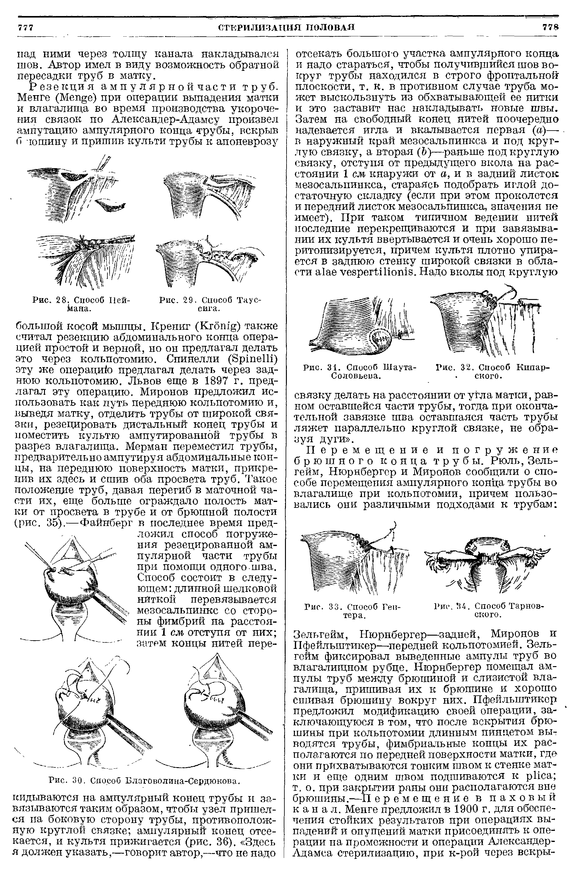 Рис. 30. Способ Благоволина-Сердюкова. кидываются на ампулярный конец трубы и завязываются таким образом, чтобы узел пришелся па боковую сторону трубы, противоположную круглой связке ампулярный конец отсекается, и культя прижигается (рис. 36). Здесь я должен указать,—говорит автор,—что не надо...