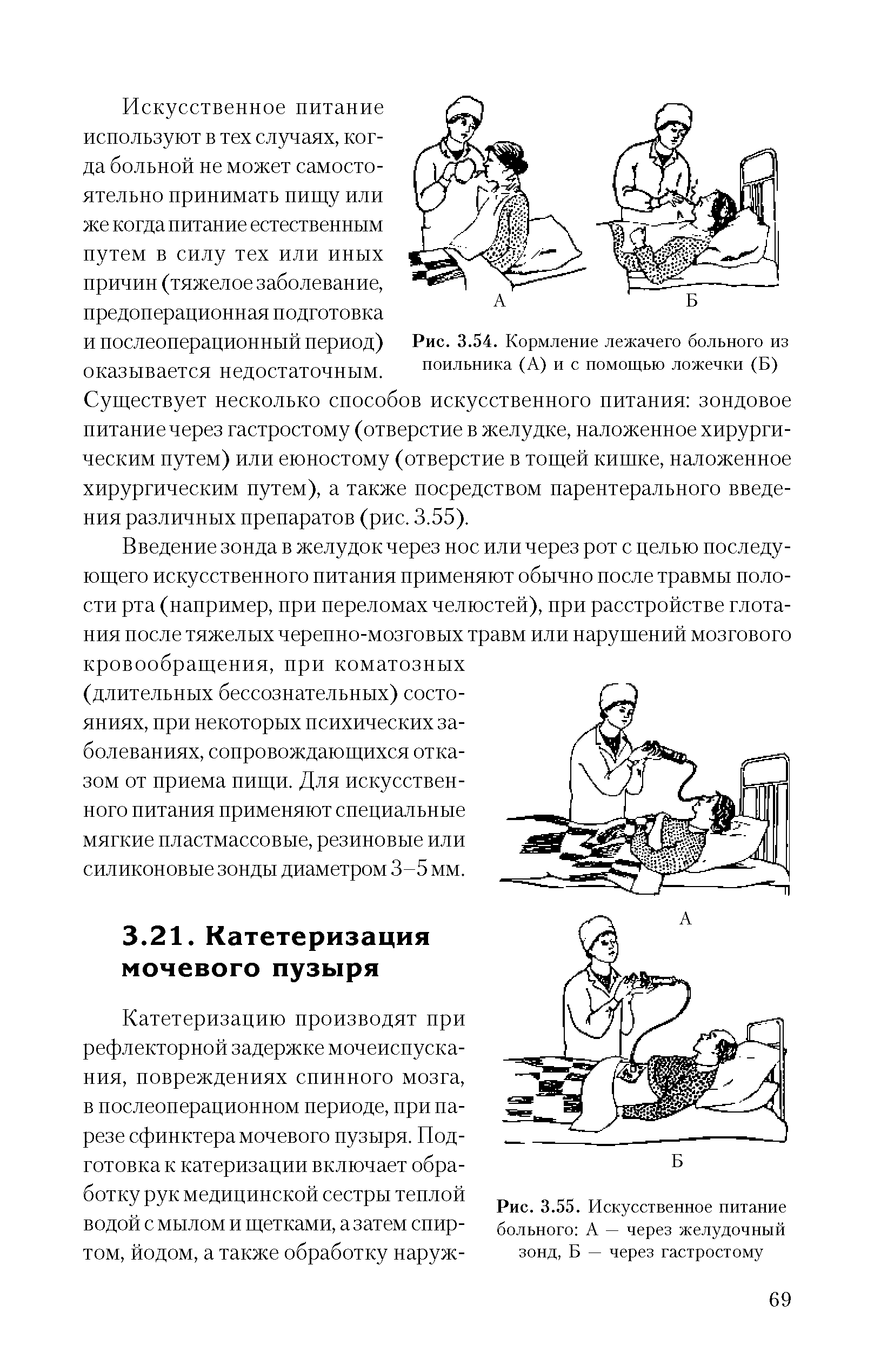 Рис. 3.55. Искусственное питание больного А — через желудочный зонд, Б — через гастростому...