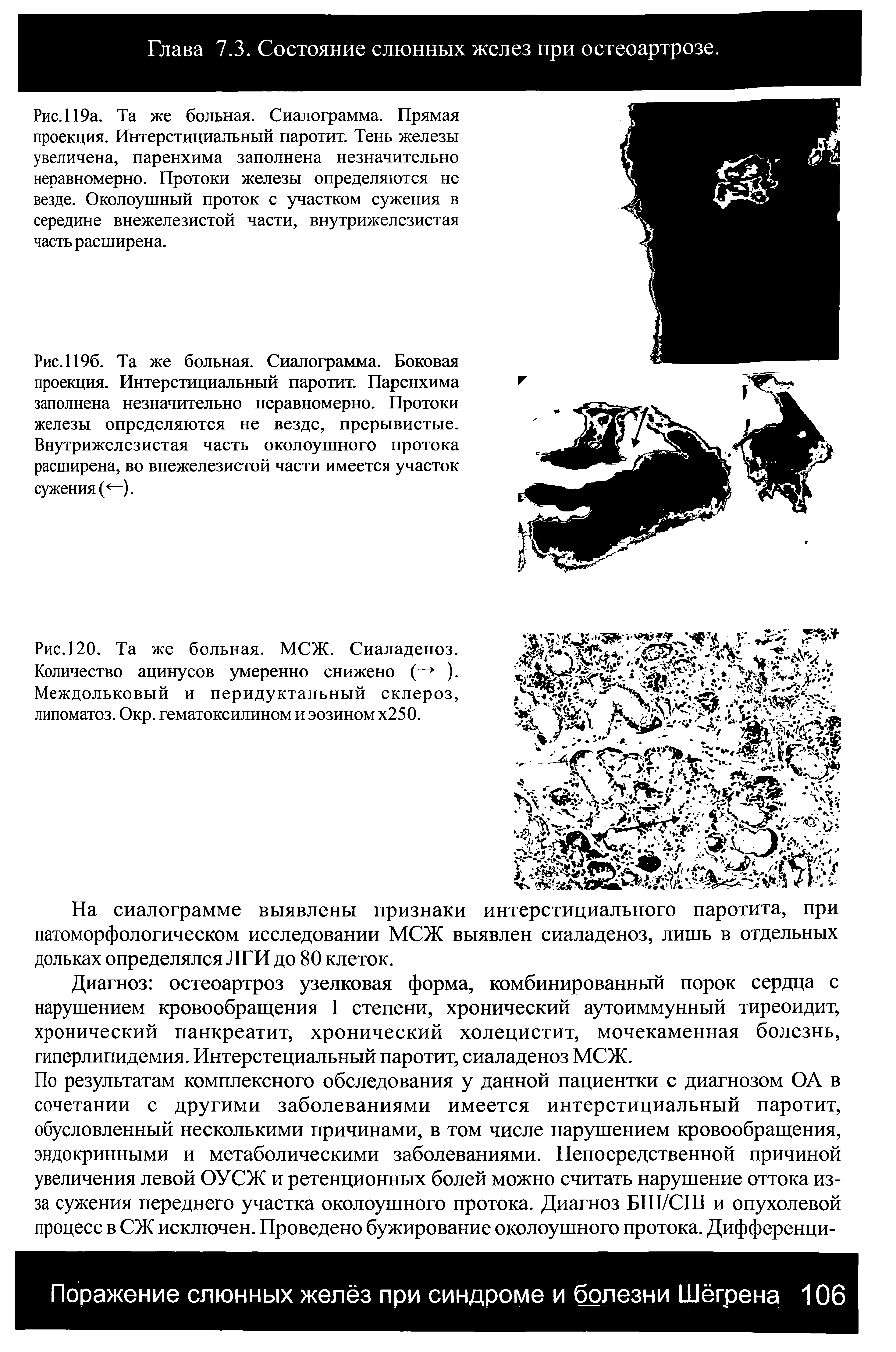 Рис. 119а. Та же больная. Сиалограмма. Прямая проекция. Интерстициальный паротит. Тень железы увеличена, паренхима заполнена незначительно неравномерно. Протоки железы определяются не везде. Околоушный проток с участком сужения в середине внежелезистой части, внутрижелезистая часть расширена.