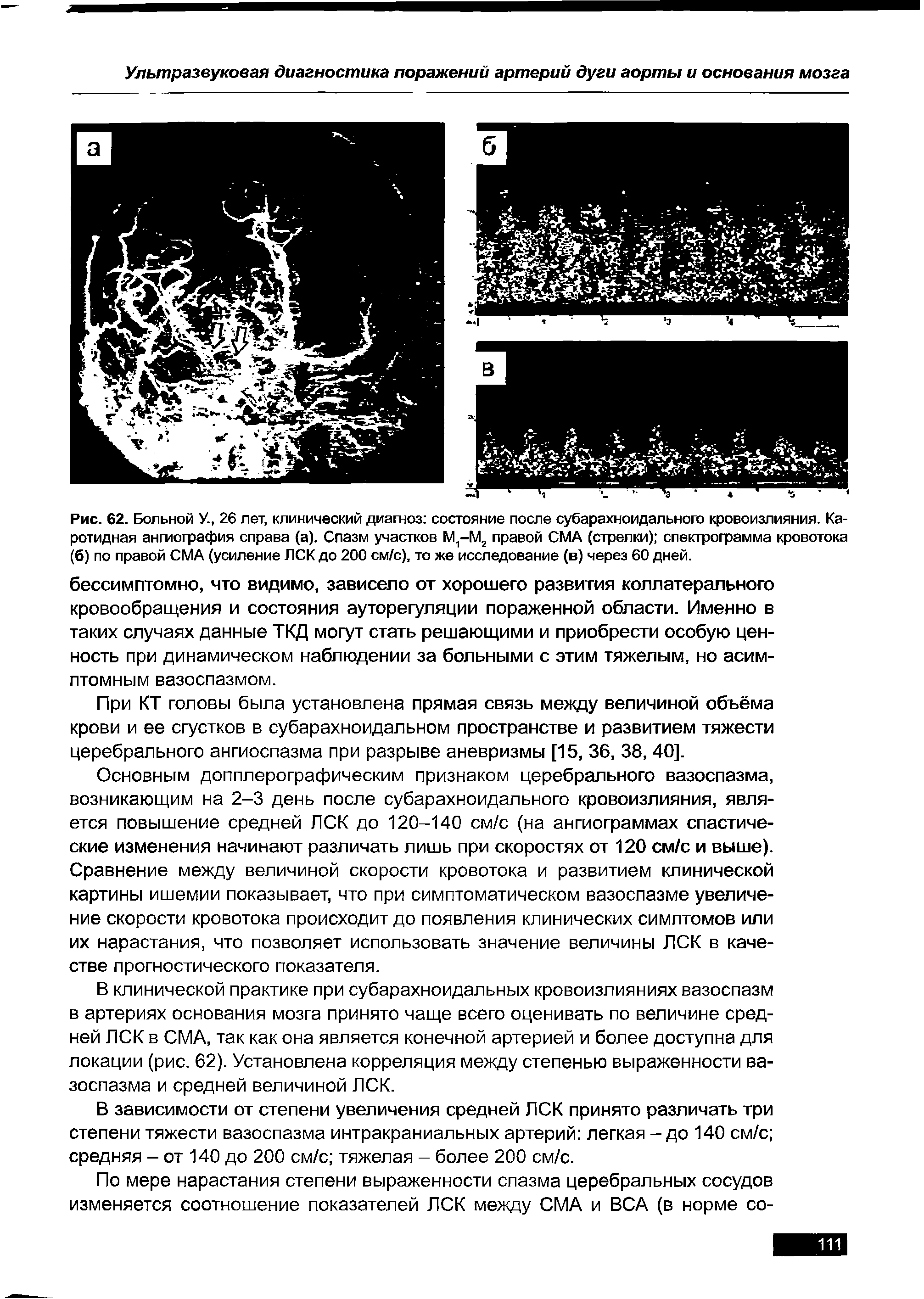 Рис. 62. Больной У., 26 лет, клинический диагноз состояние после субарахноидального кровоизлияния. Каротидная ангиография справа (а). Спазм участков М,-М2 правой СМА (стрелки) спектрограмма кровотока (б) по правой СМА (усиление ЛСК до 200 см/с), то же исследование (в) через 60 дней.