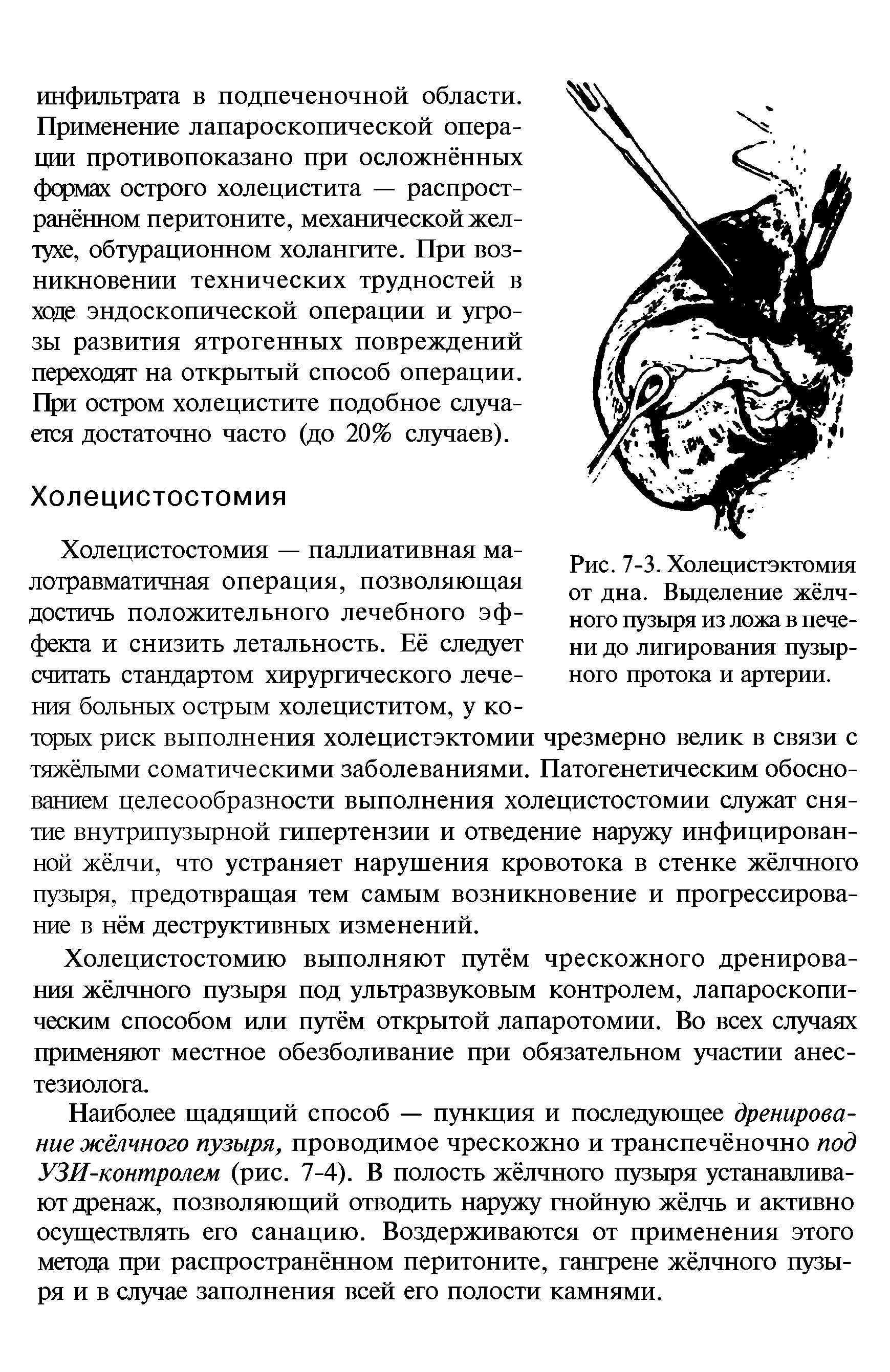 Рис. 7-3. Холецистэктомия от дна. Выделение жёлчного пузыря из ложа в печени до лигирования пузырного протока и артерии.