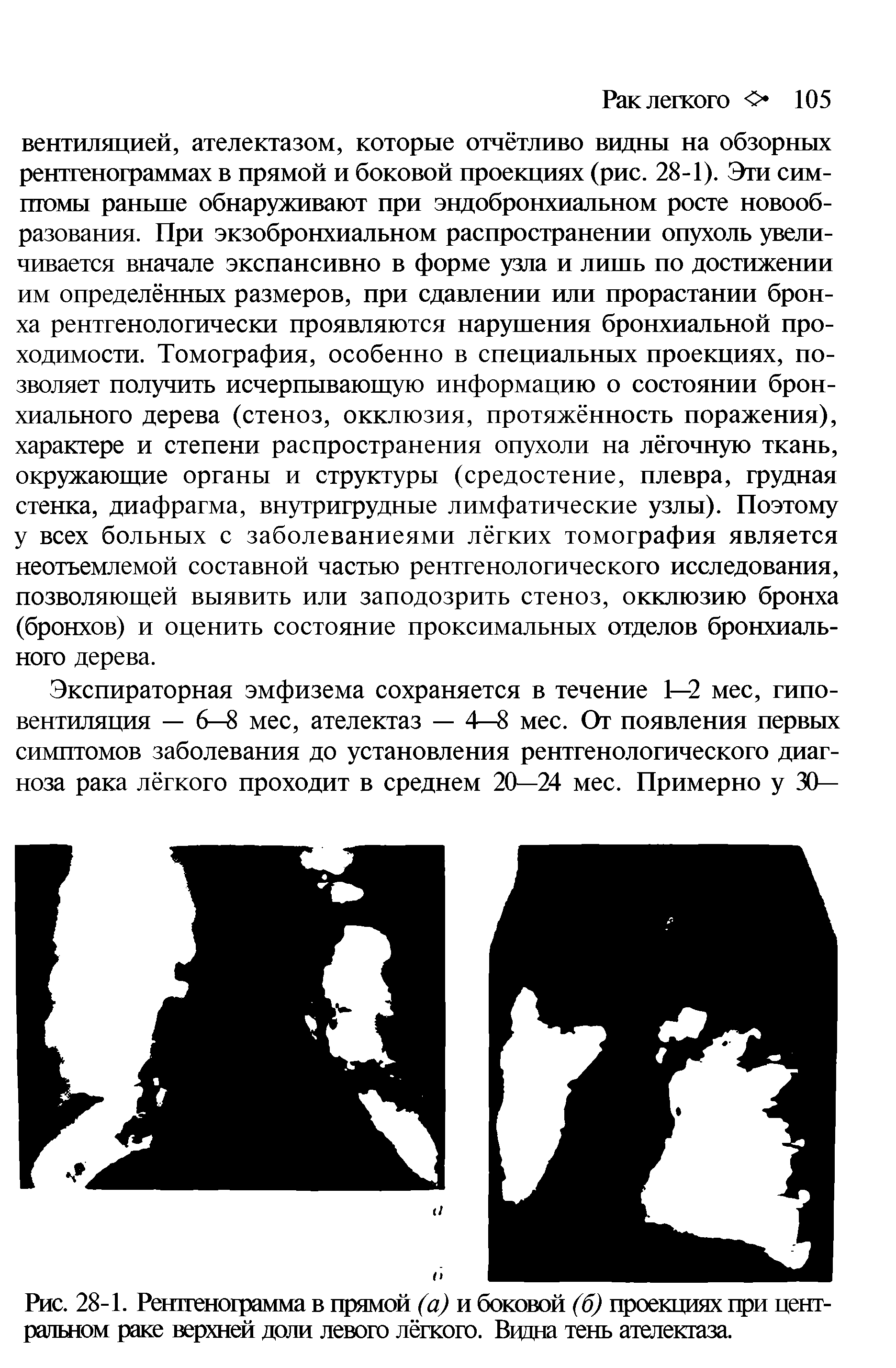 Рис. 28-1. Рентгенограмма в прямой (а) и боковой (б) проекциях при центральном раке верхней доли левого лёгкого. Видна тень ателектаза.