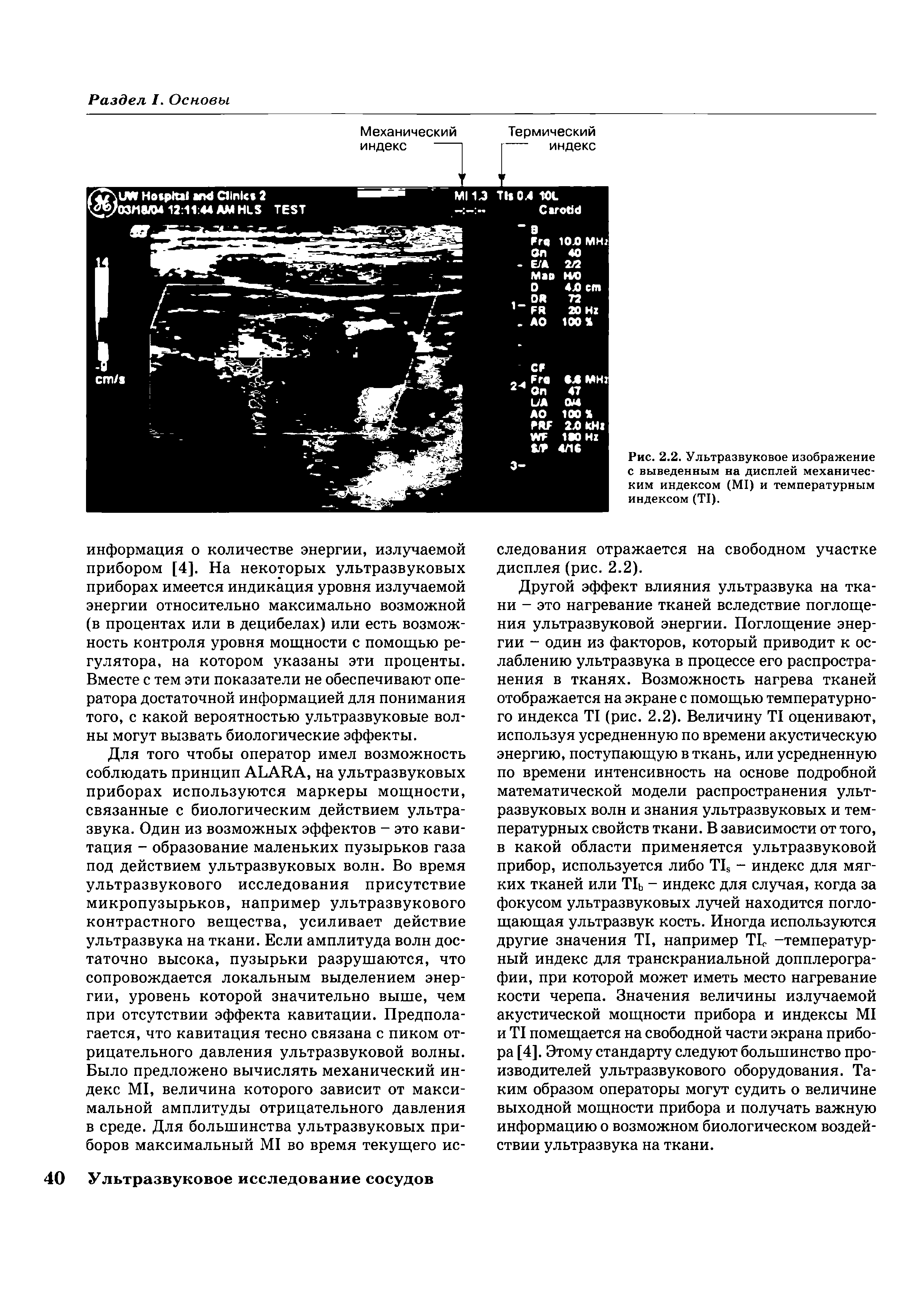 Рис. 2.2. Ультразвуковое изображение с выведенным на дисплей механическим индексом (М1) и температурным индексом (Т1).