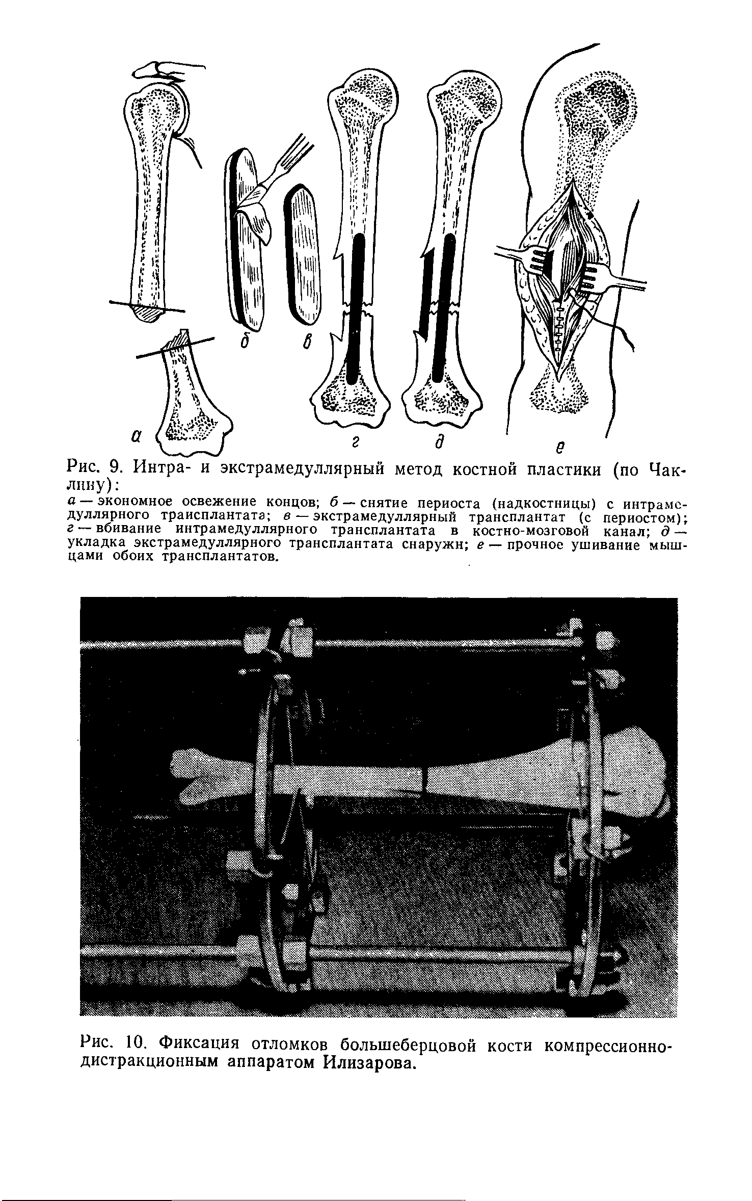 Рис. 10. Фиксация отломков большеберцовой кости компрессионнодистракционным аппаратом Илизарова.