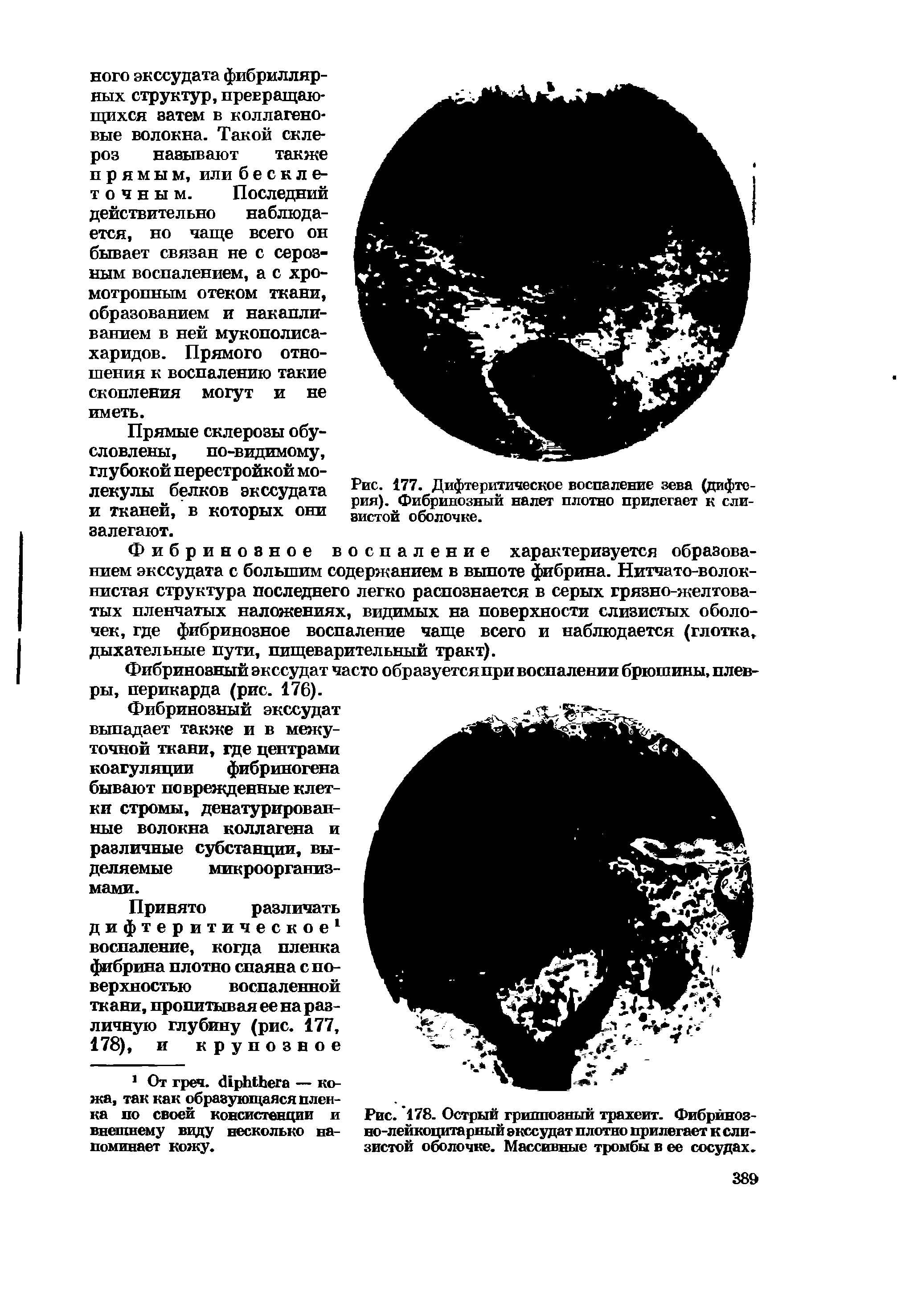 Рис. 178. Острый гриппозный трахеит. Фибринозно-лейкоцитарный экссудат плотно прилегает к слизистой оболочке. Массивные тромбы в ее сосудах.