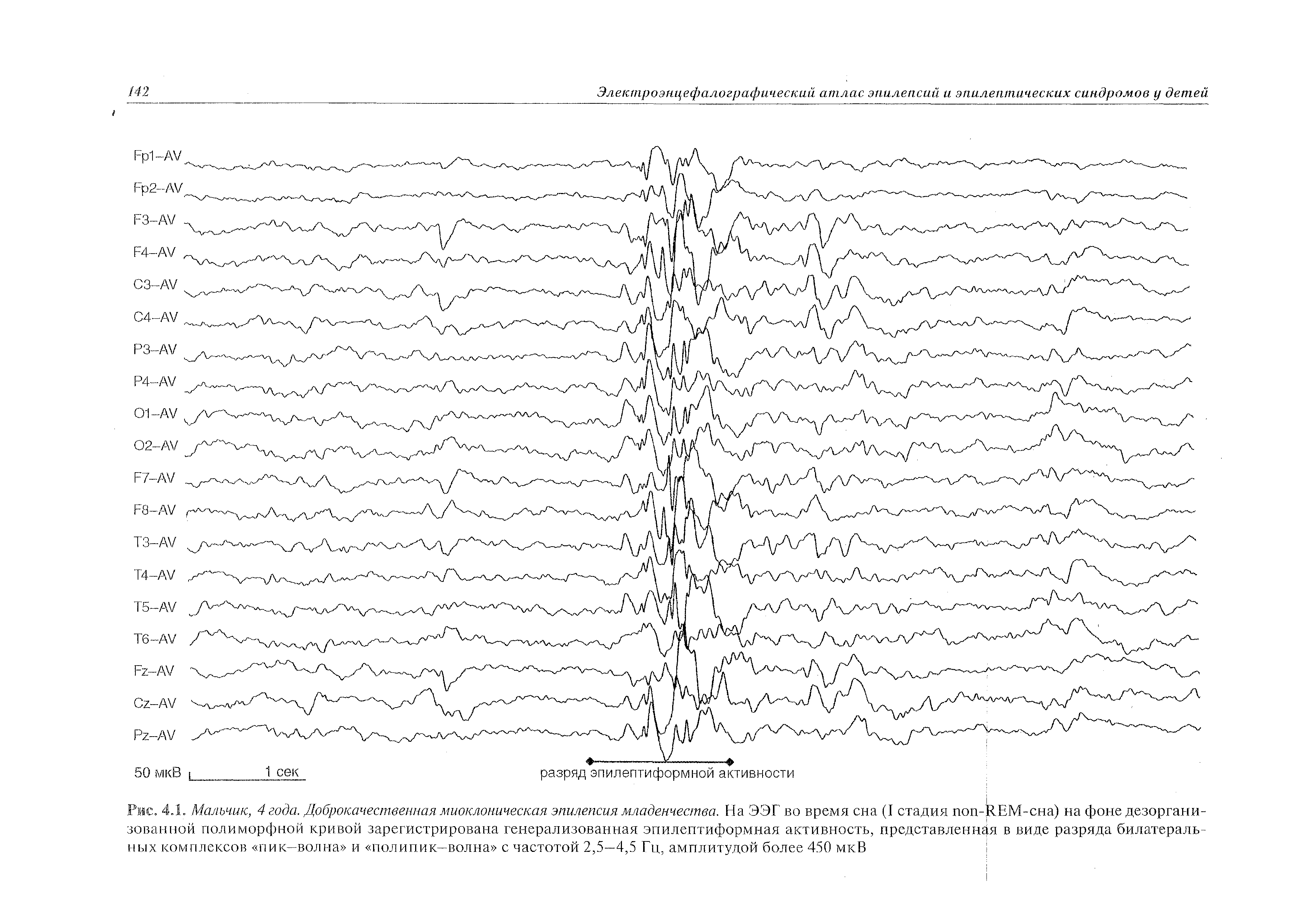 Рис. 4.1. Мальчик, 4 года. Доброкачественная миоклоническая эпилепсия младенчества. На ЭЭГ во время сна (I стадия поп-ЯЕМ-сна) на фоне дезорганизованной полиморфной кривой зарегистрирована генерализованная эпилептиформная активность, представленная в виде разряда билатеральных комплексов пик—волна и полипик—волна с частотой 2,5—4,5 Гц, амплитудой более 450 мкВ...