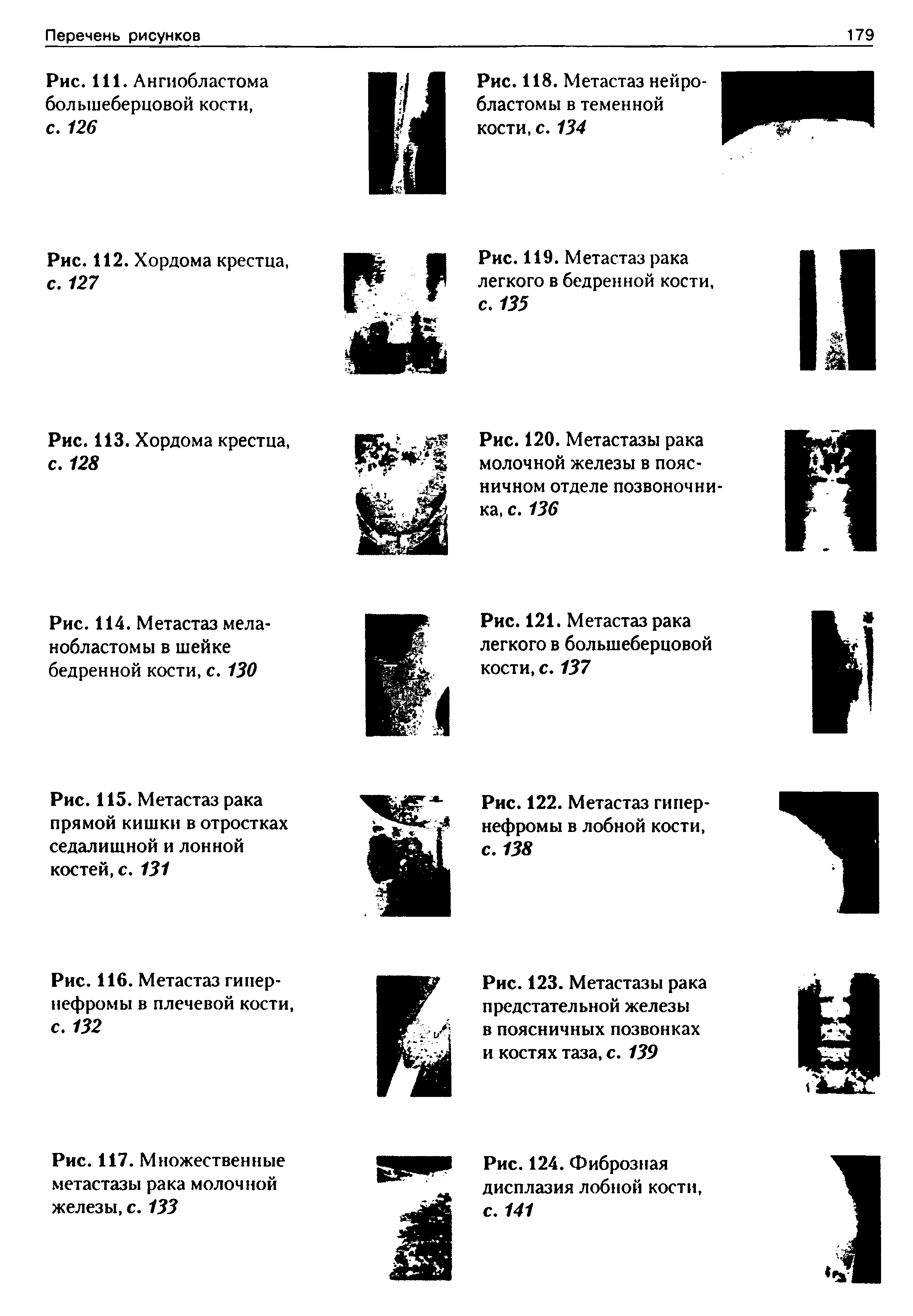 Рис. 114. Метастаз мела-нобластомы в шейке бедренной кости, с. 130...