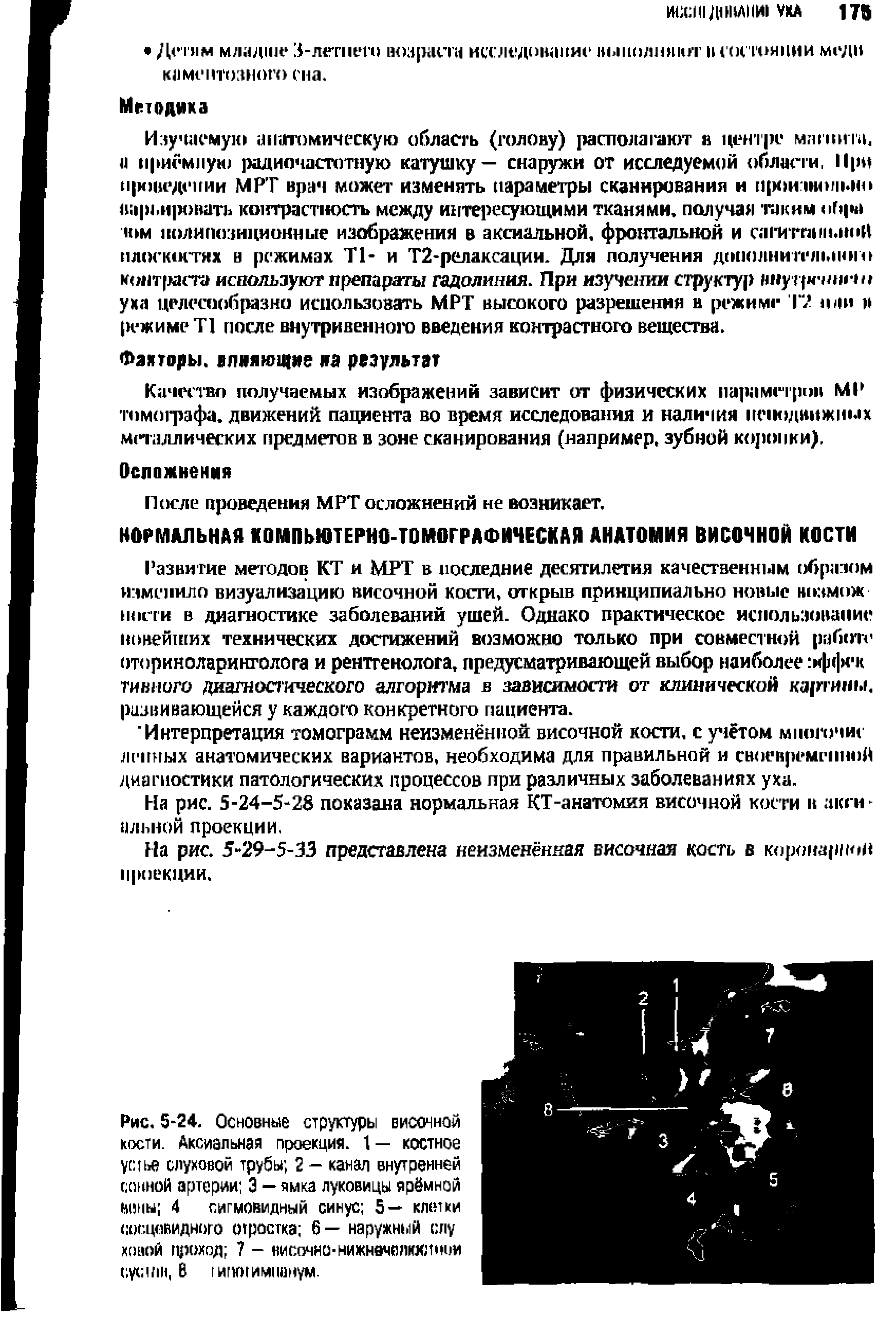 Рис. 5-24. Основные структуры височной кости. Аксиальная проекция. 1 — костное устье слуховой трубы 2 — канал внутренней сонной артерии 3 — ямка луковицы ярёмной вины 4 сигмовидный синус 5— клюки сосцевидного отростка 6 — наружный слу новой проход 7 - нисочно-нижнвчйлкхдтши H, В типогимианум.