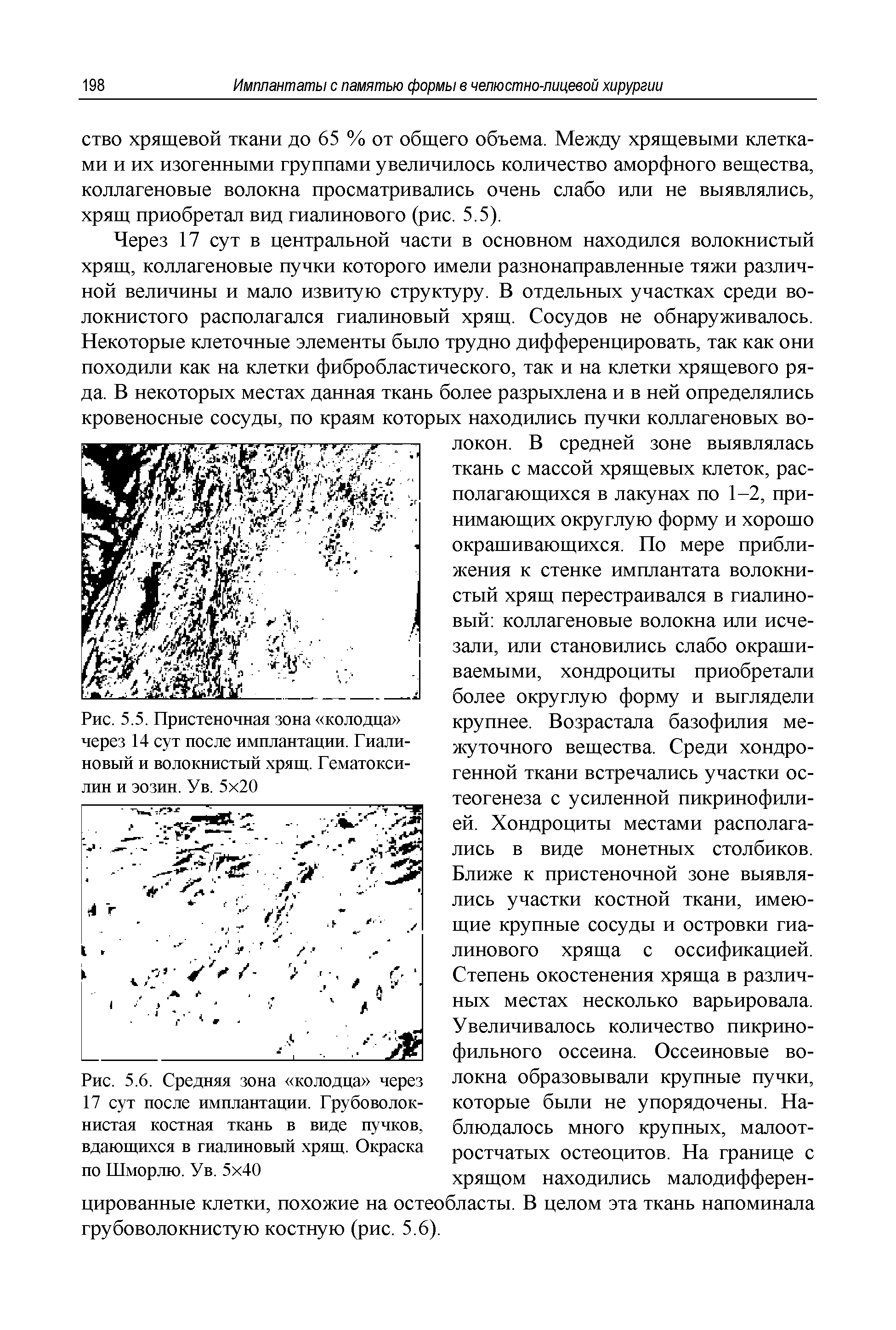 Рис. 5.6. Средняя зона колодца через 17 сут после имплантации. Грубоволокнистая костная ткань в виде пучков, вдающихся в гиалиновый хрящ. Окраска по Шморлю. Ув. 5 40...